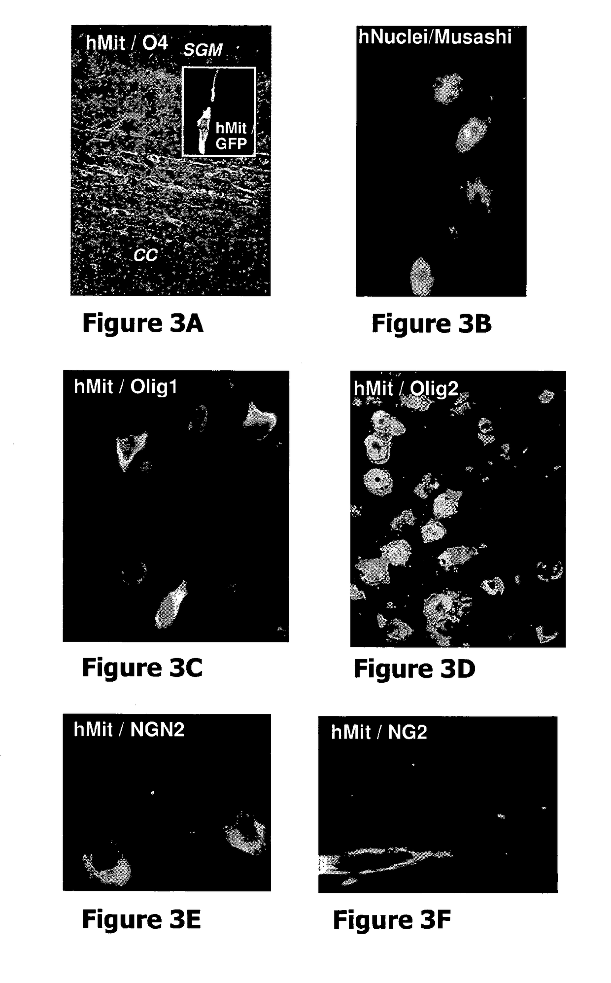 Human stem cell-derived neural precursors for treatment of autoimmune diseases of the central nervous system