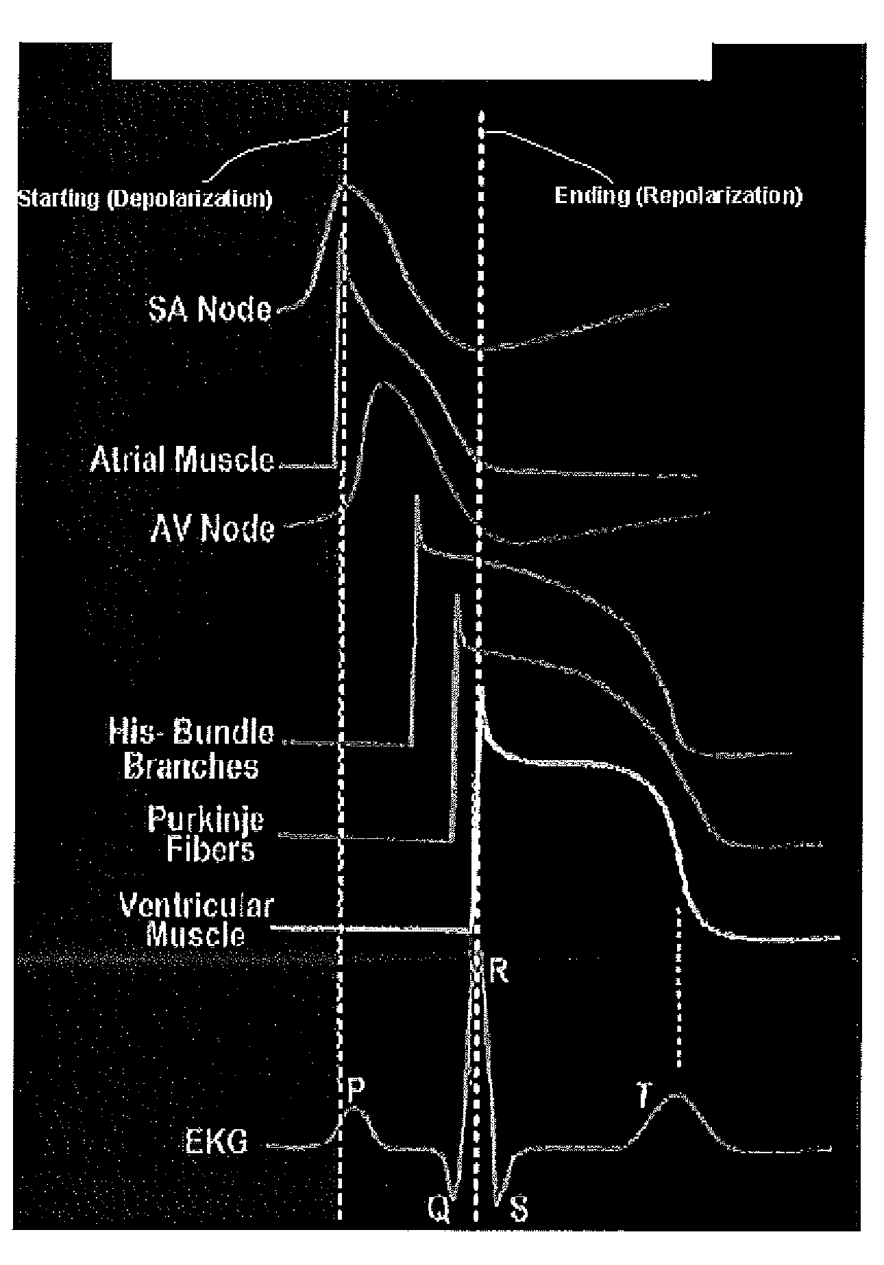 System for Cardiac Medical Condition Detection