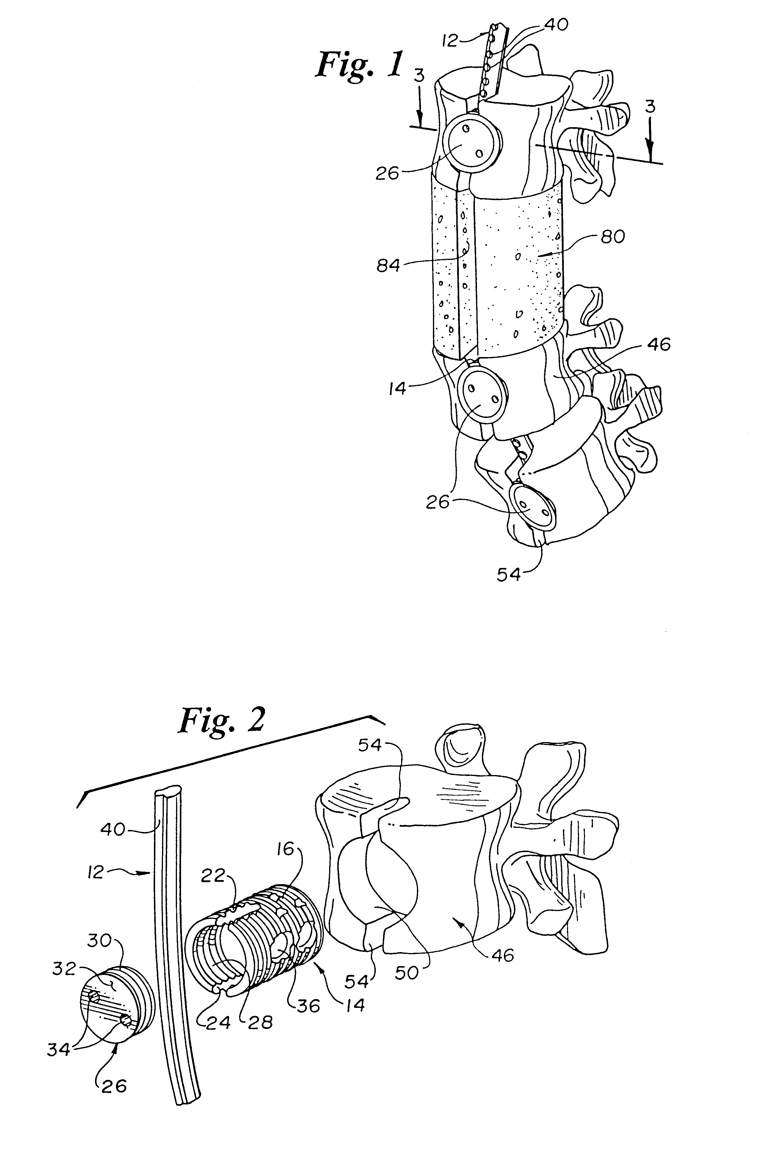 Spinal fixation device