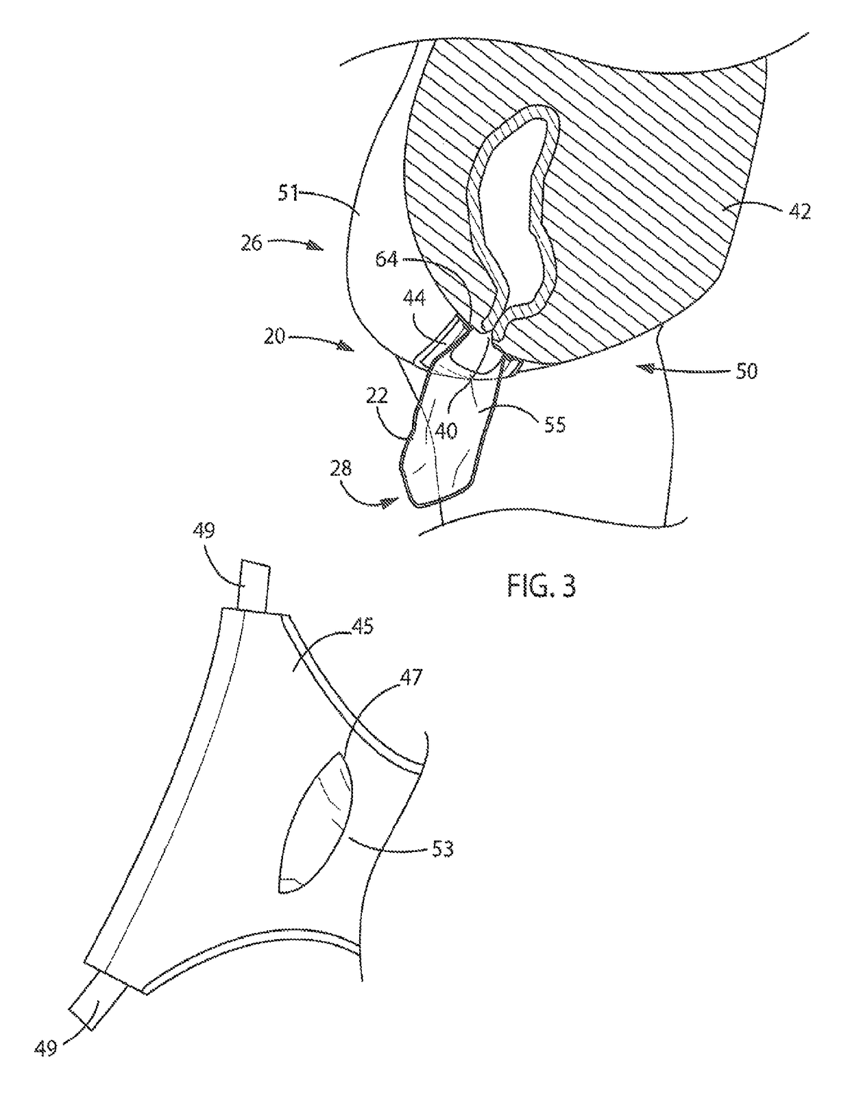 Fecal matter containment device