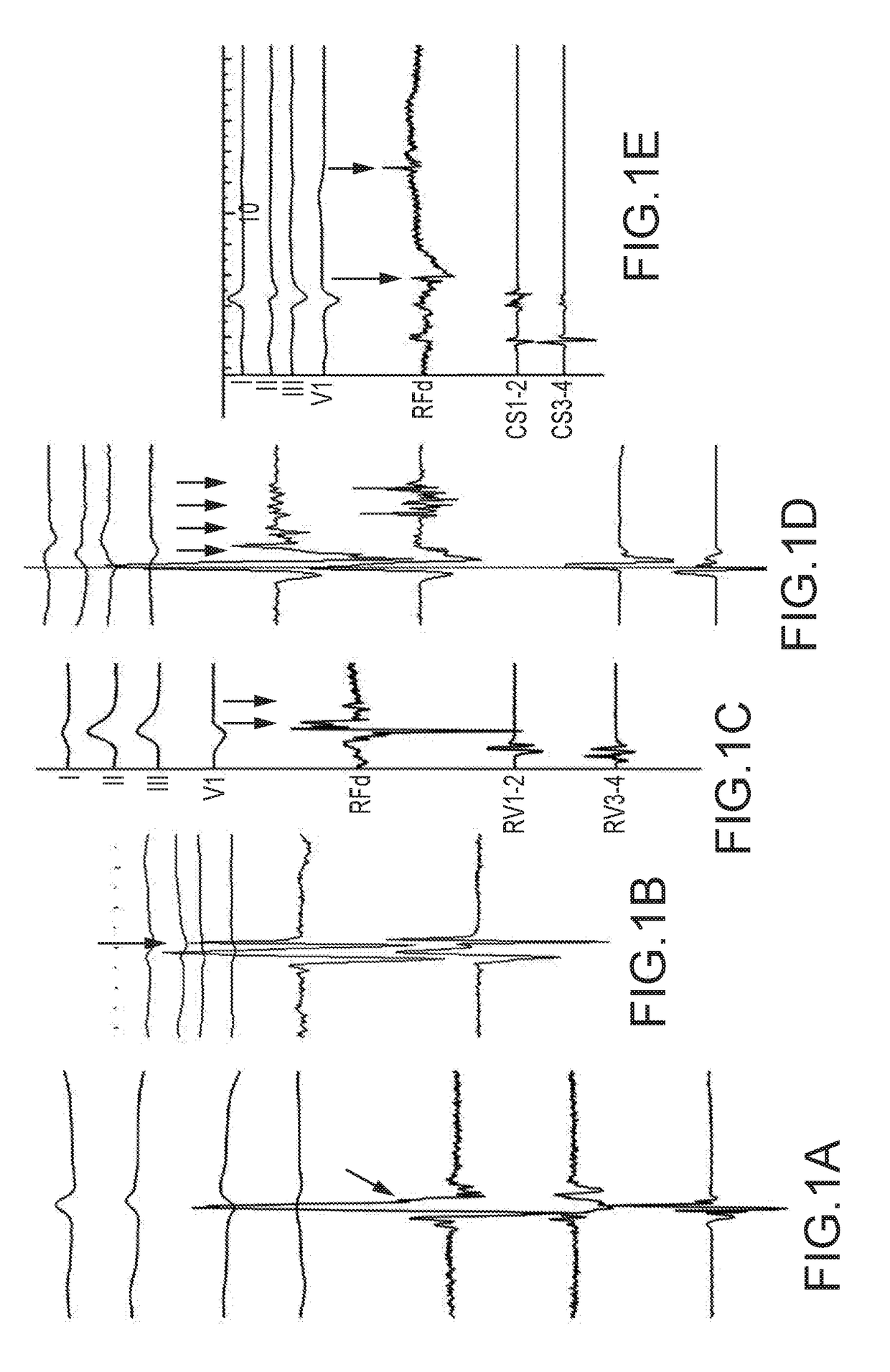 Methods and Systems for Statistically Analyzing Electrograms for Local Abnormal Ventricular Activities and Mapping the Same