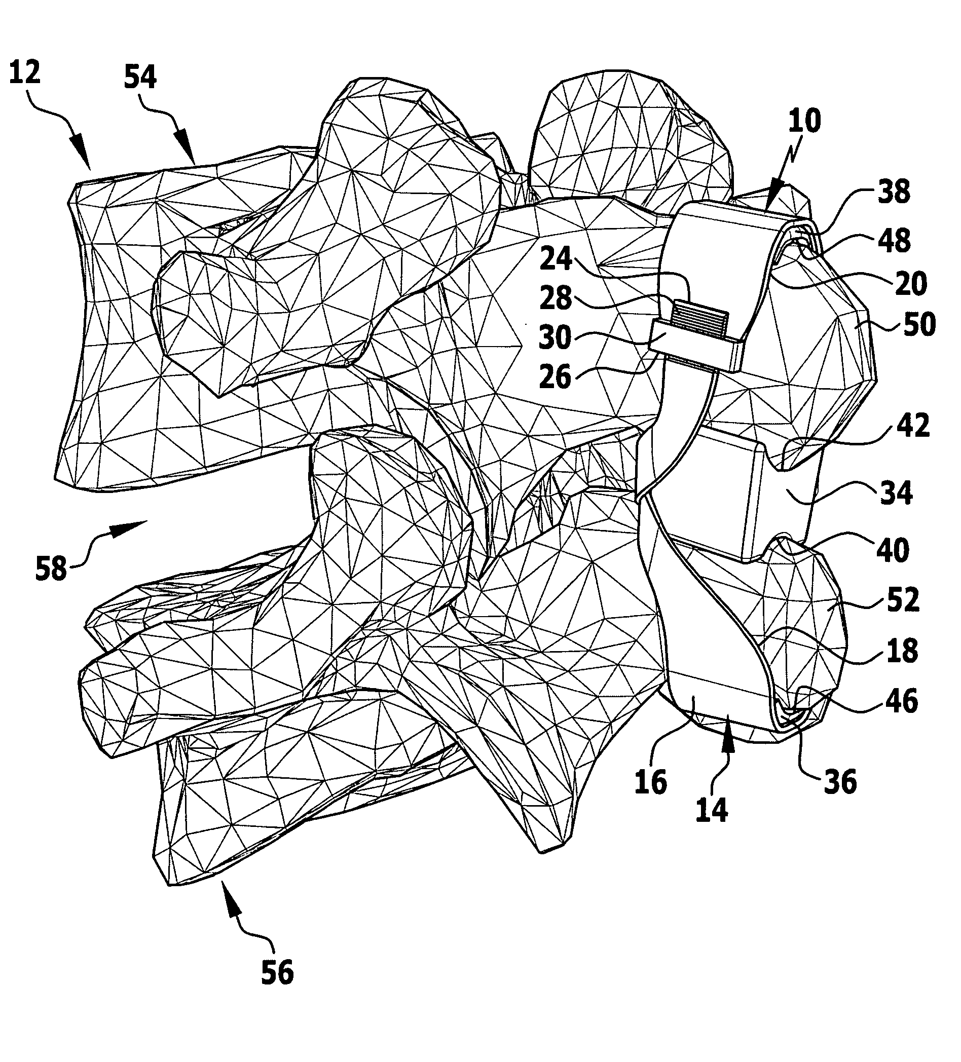 Implant and implant system