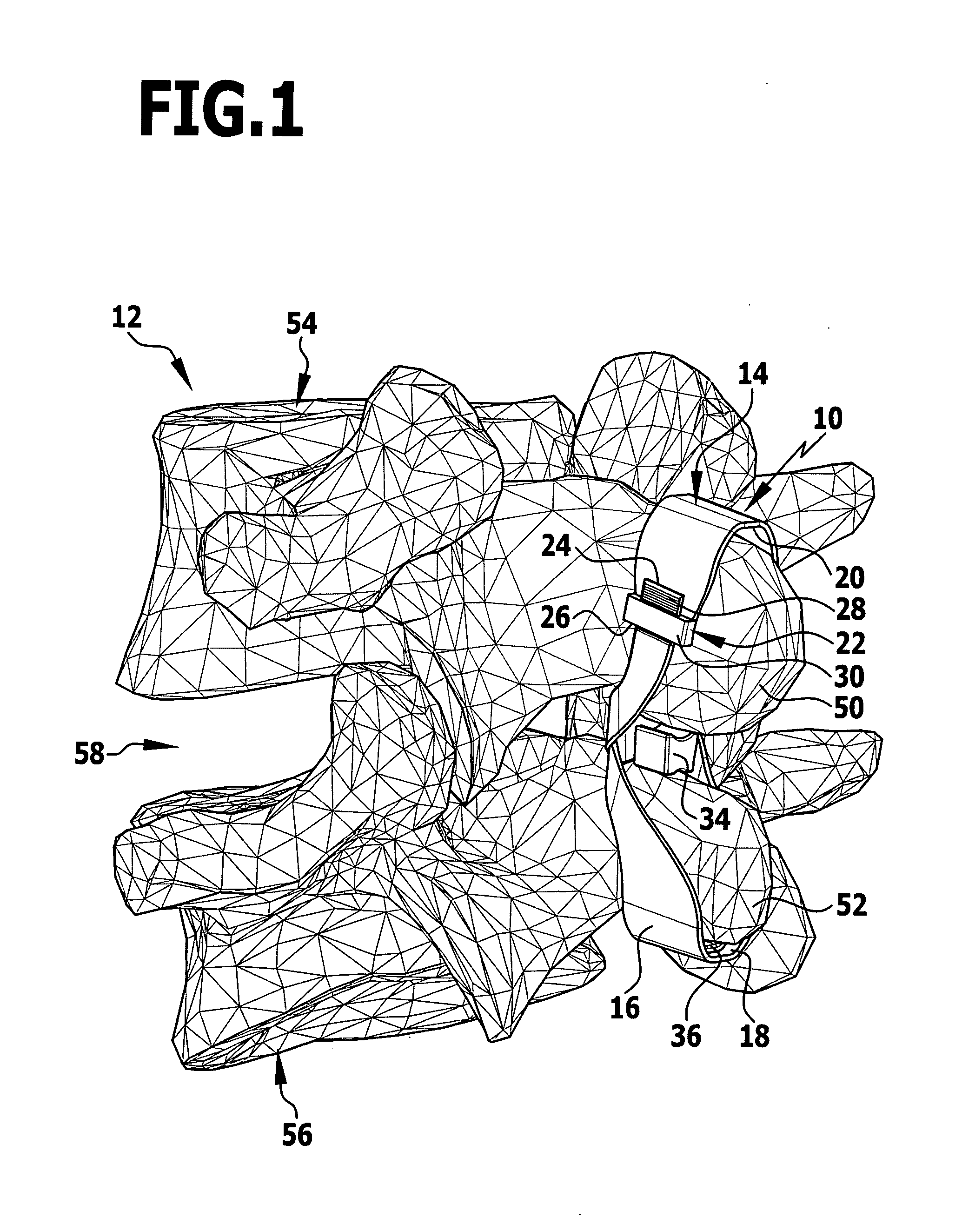 Implant and implant system