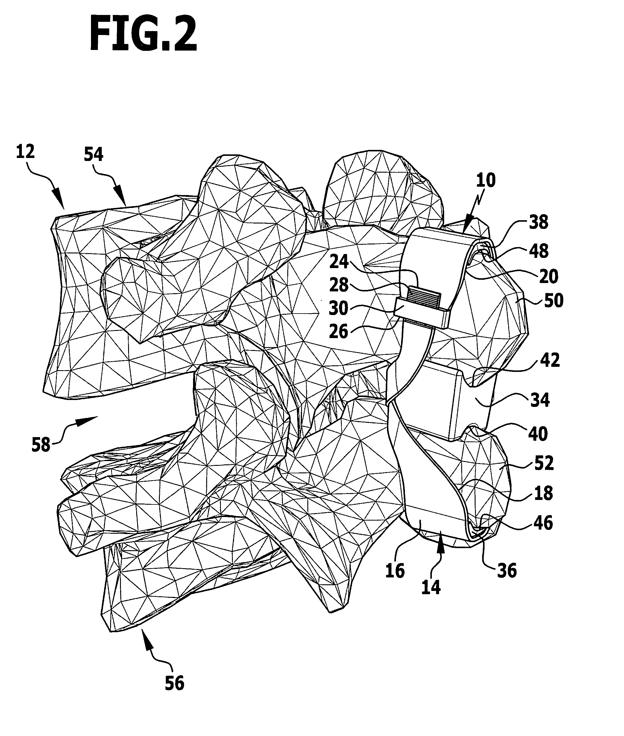 Implant and implant system