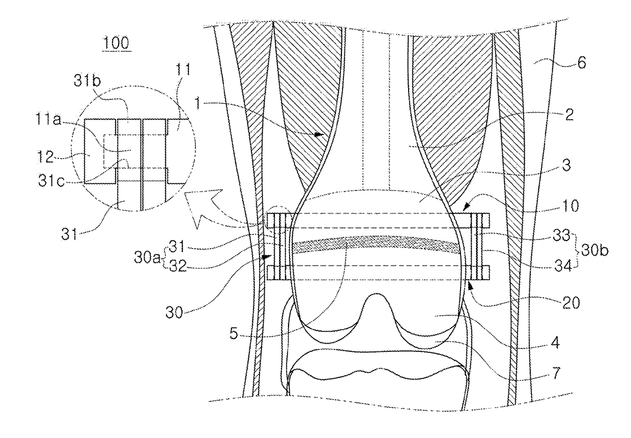 Implant device for promoting bone growth