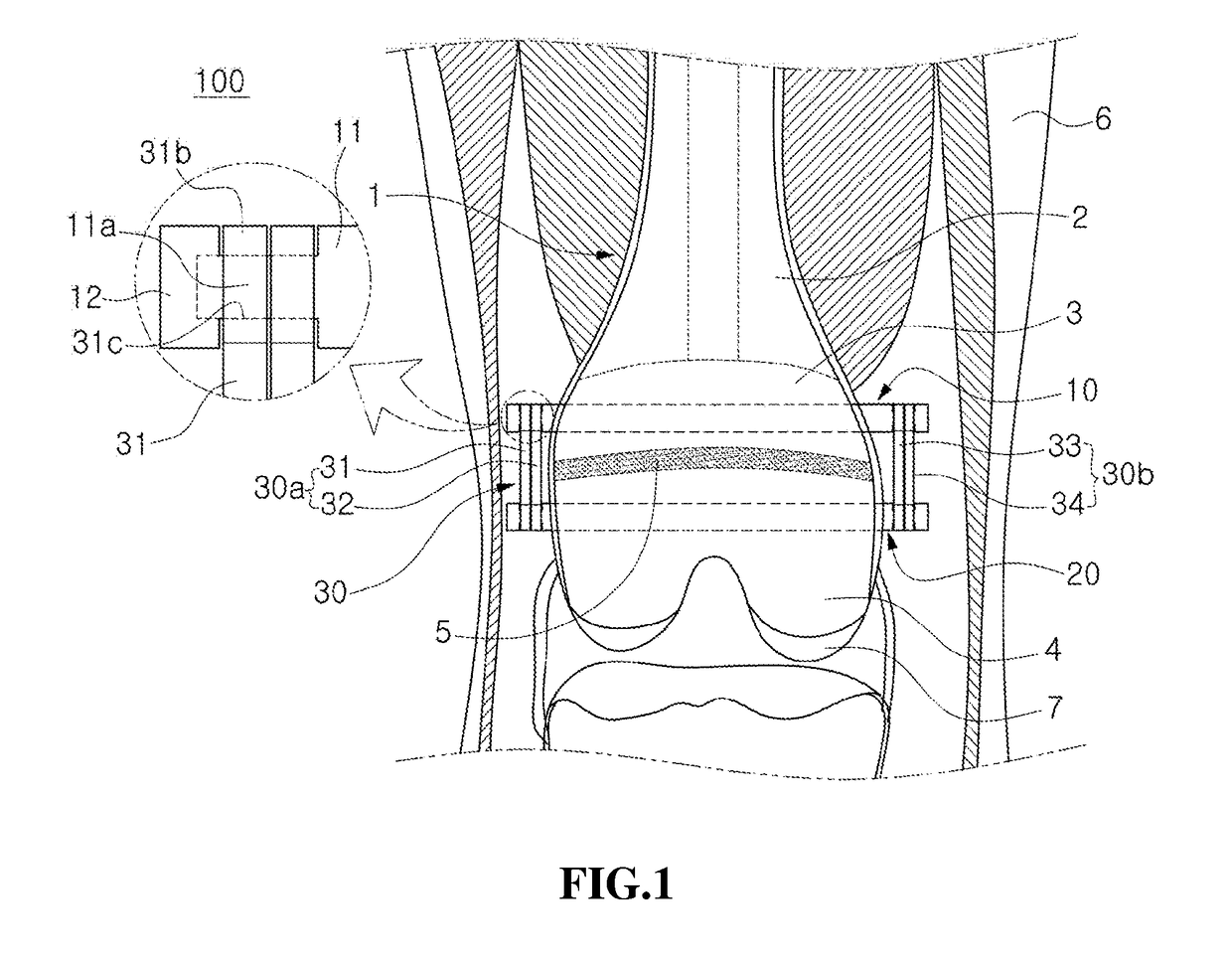 Implant device for promoting bone growth