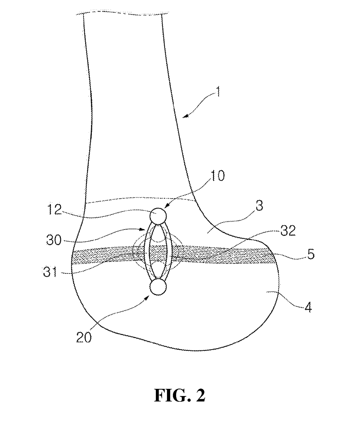 Implant device for promoting bone growth