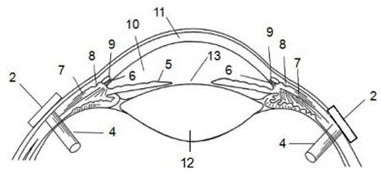 A method and device for reducing intraocular vegf concentration