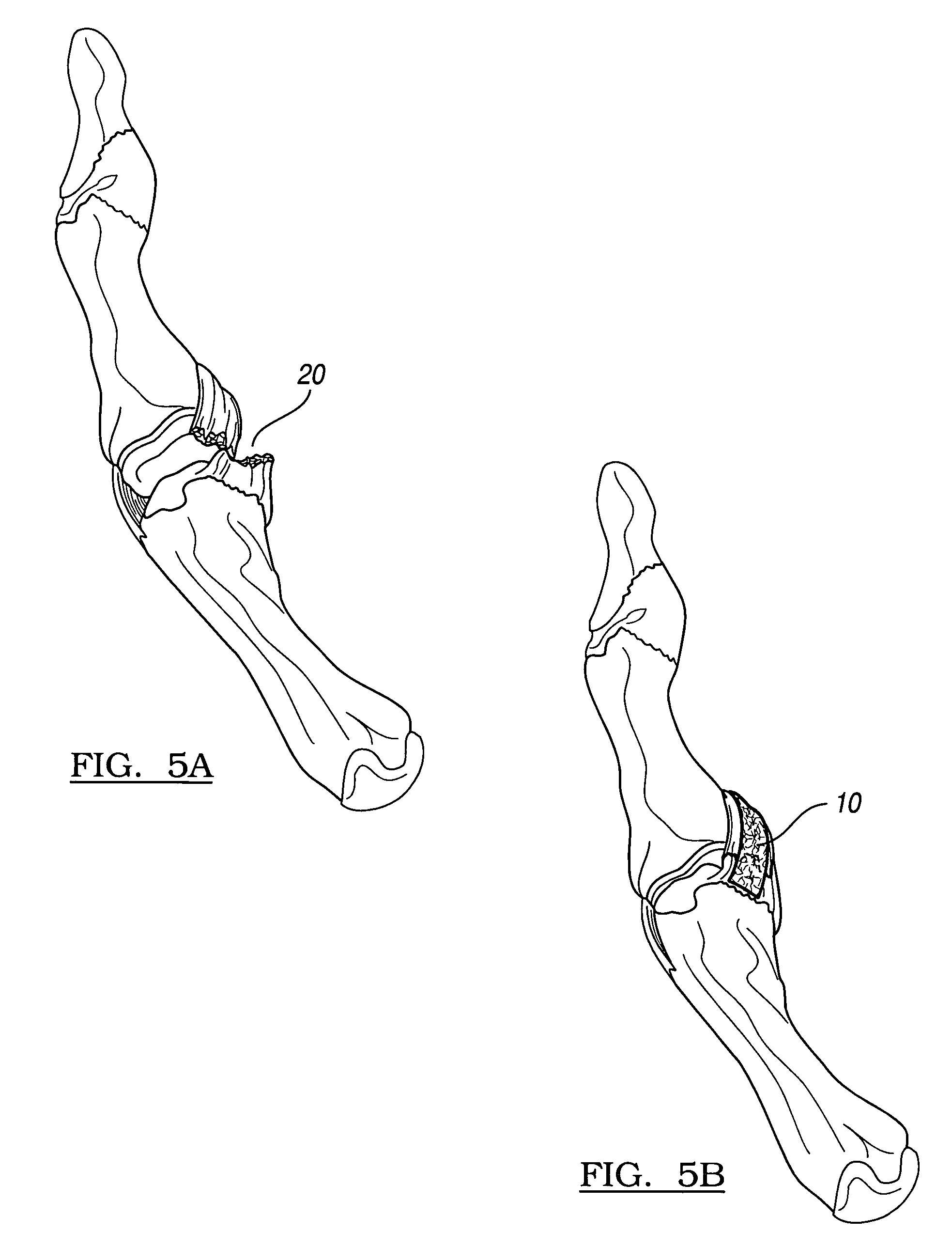 Composite collagen material and method of forming same