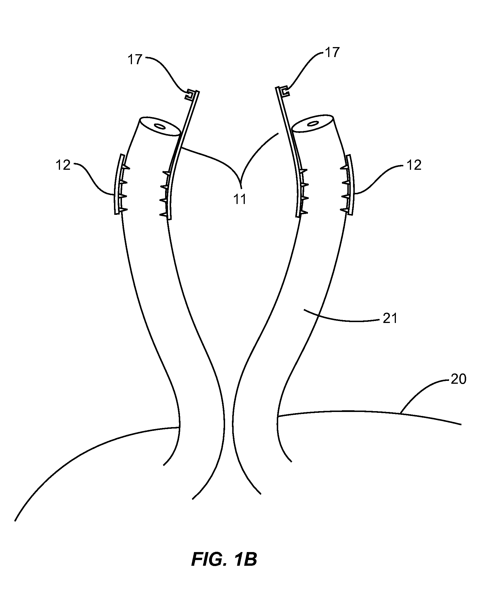 Vas deferens vasectomy capping device