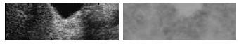 Medical image lesion area segmentation method based on energy functional model of machine learning