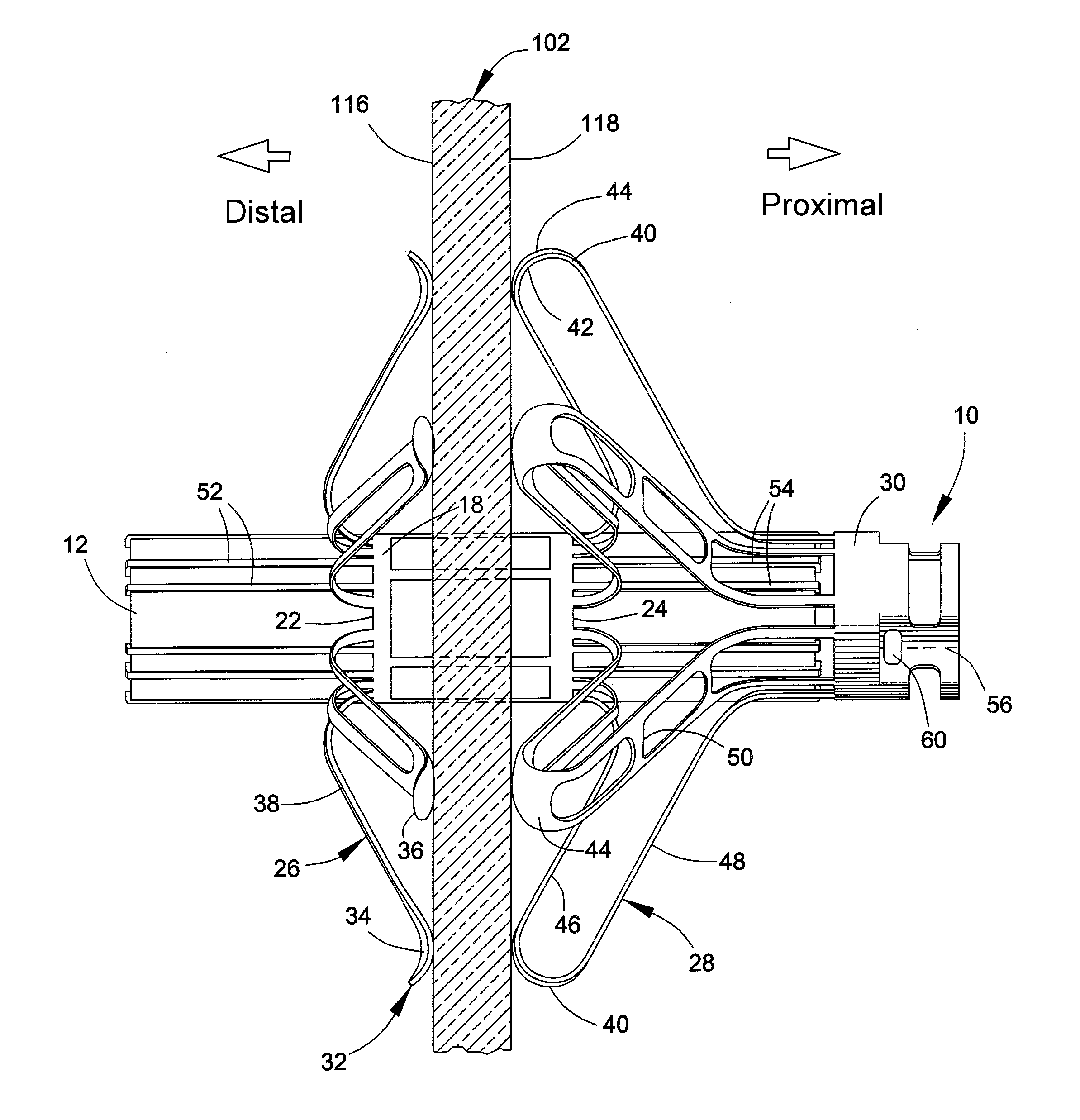 Delivery system, method, and anchor for medical implant placement