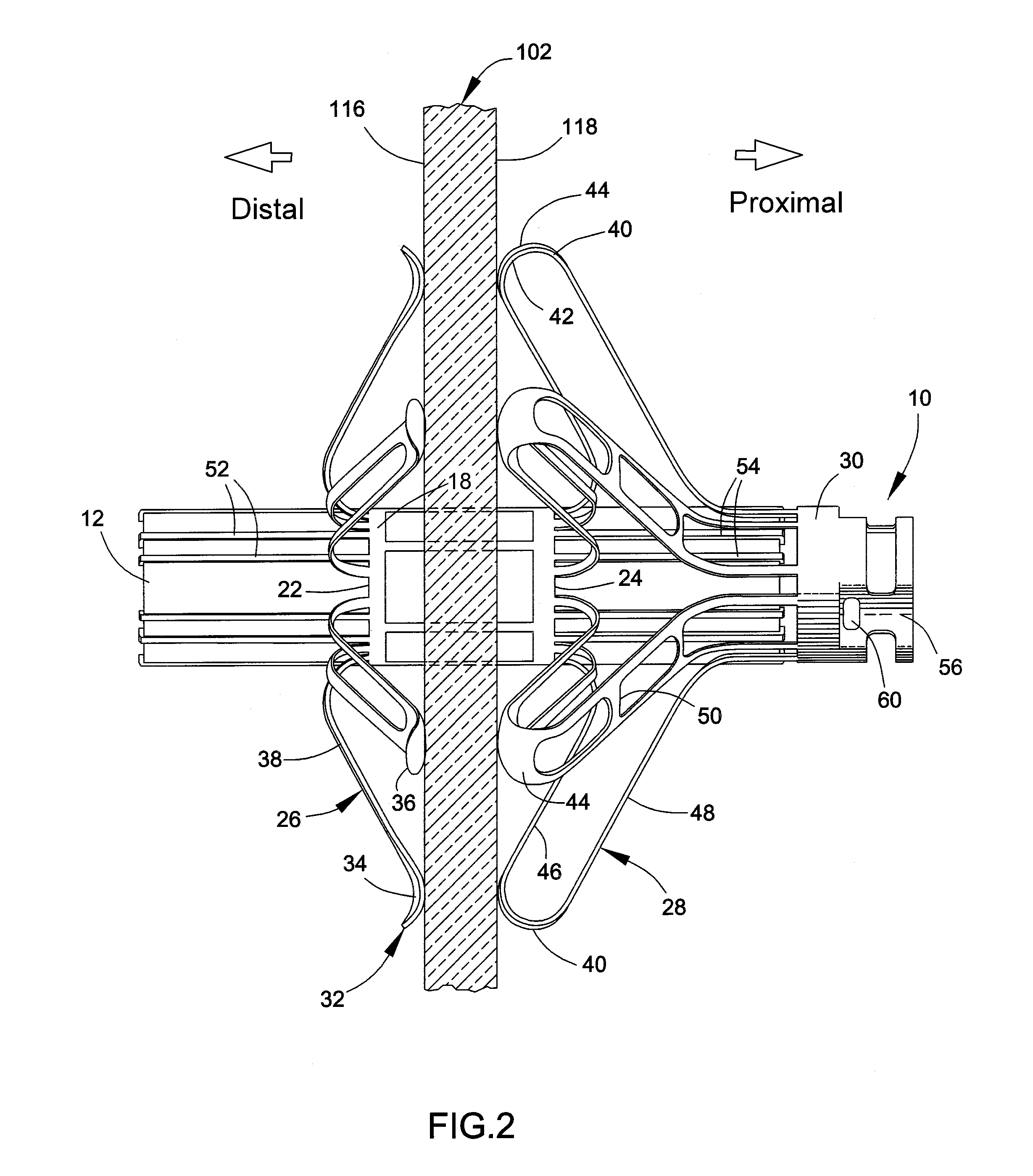 Delivery system, method, and anchor for medical implant placement