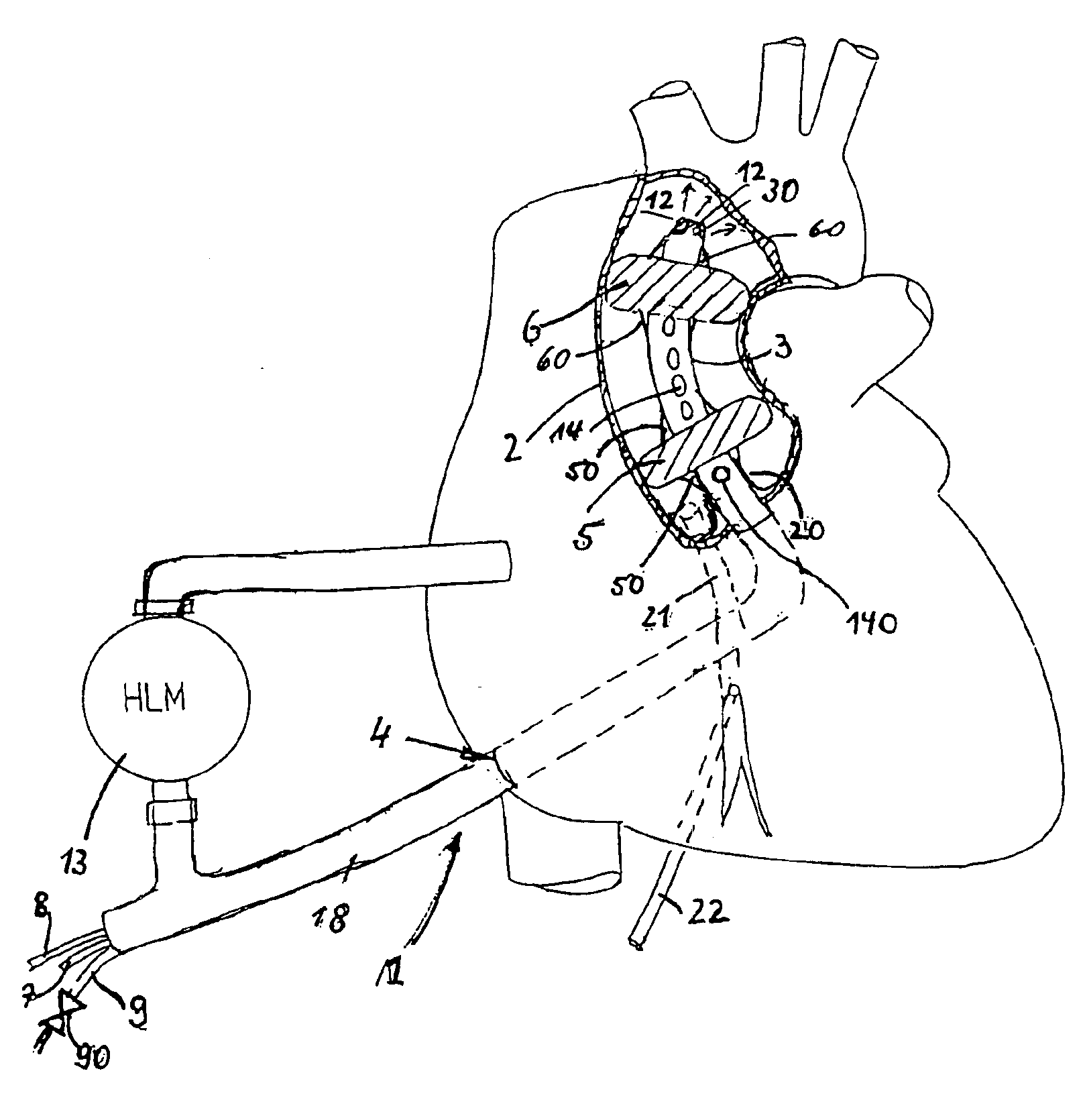 Aortic balloon occlusion cannula