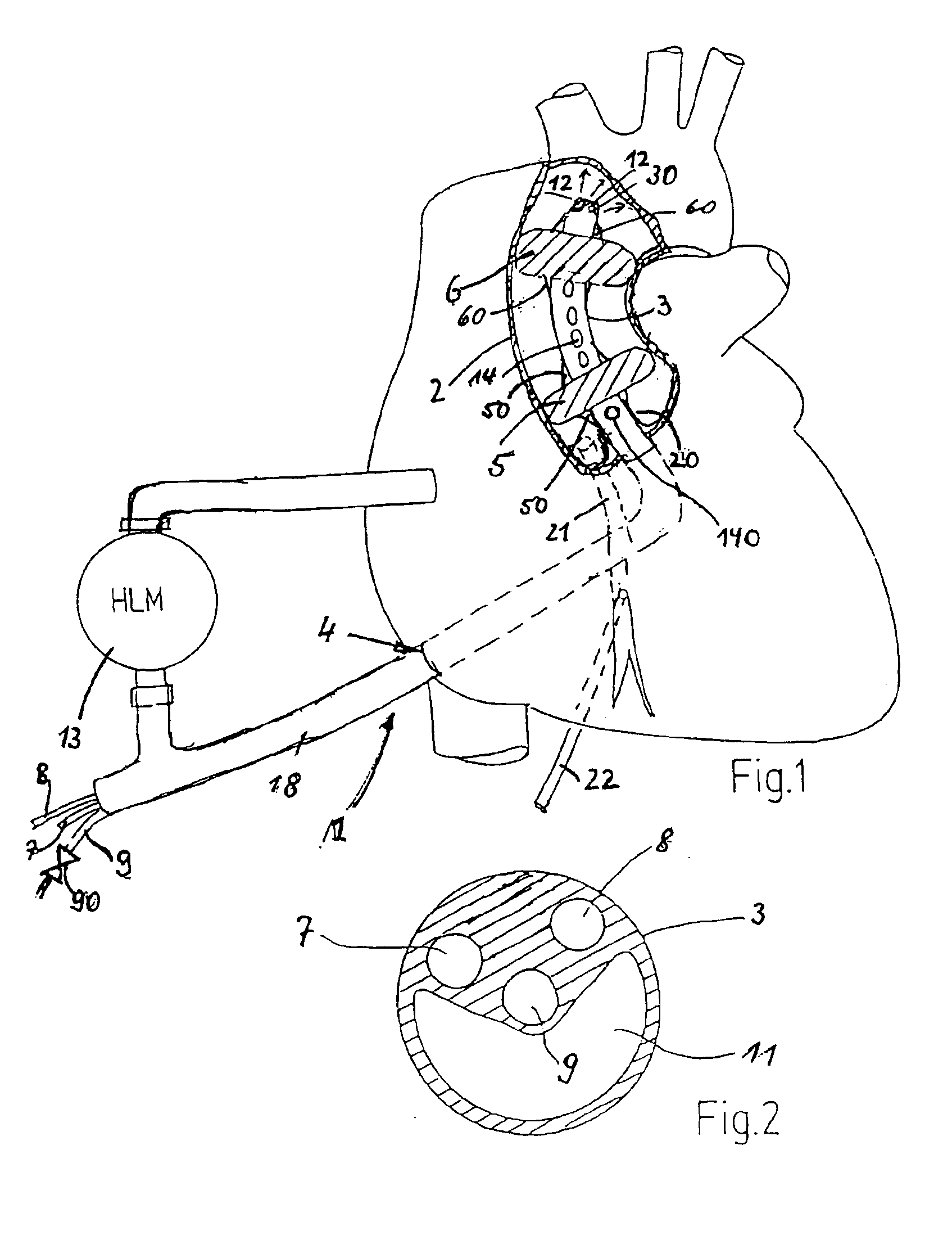 Aortic balloon occlusion cannula