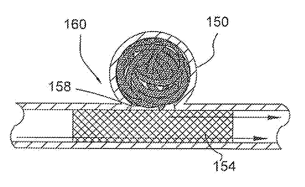 Micrograft for the treatment of intracranial aneurysms and method for use