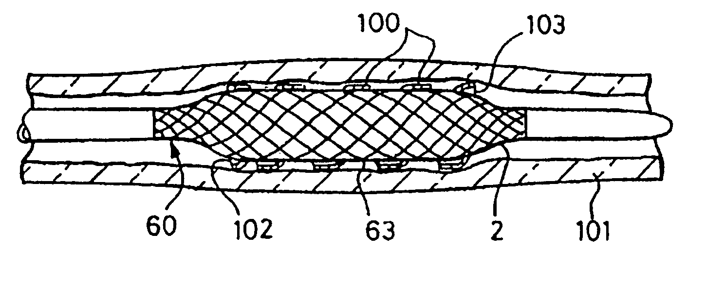 Balloon catheter