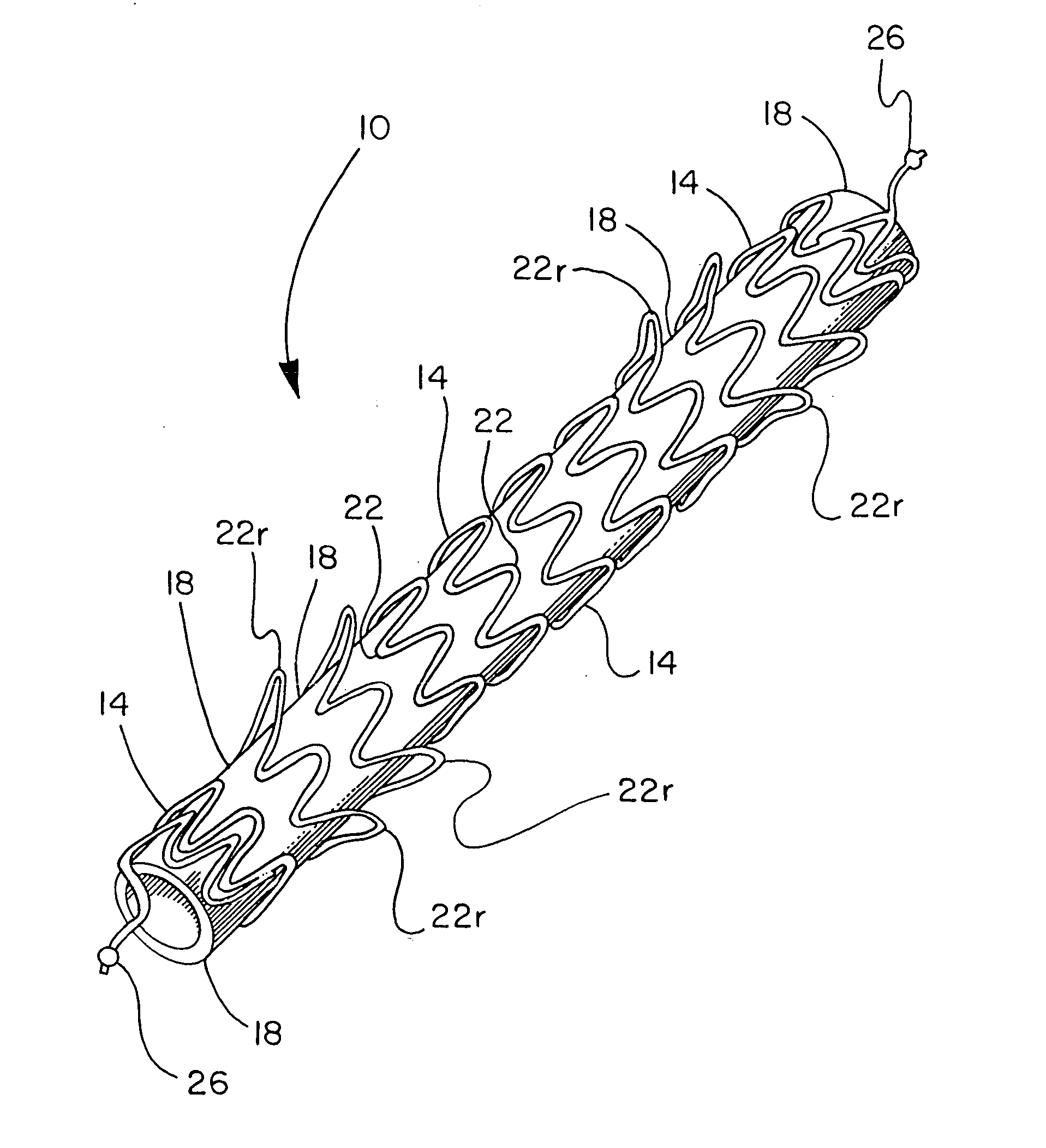 Removable stent-graft