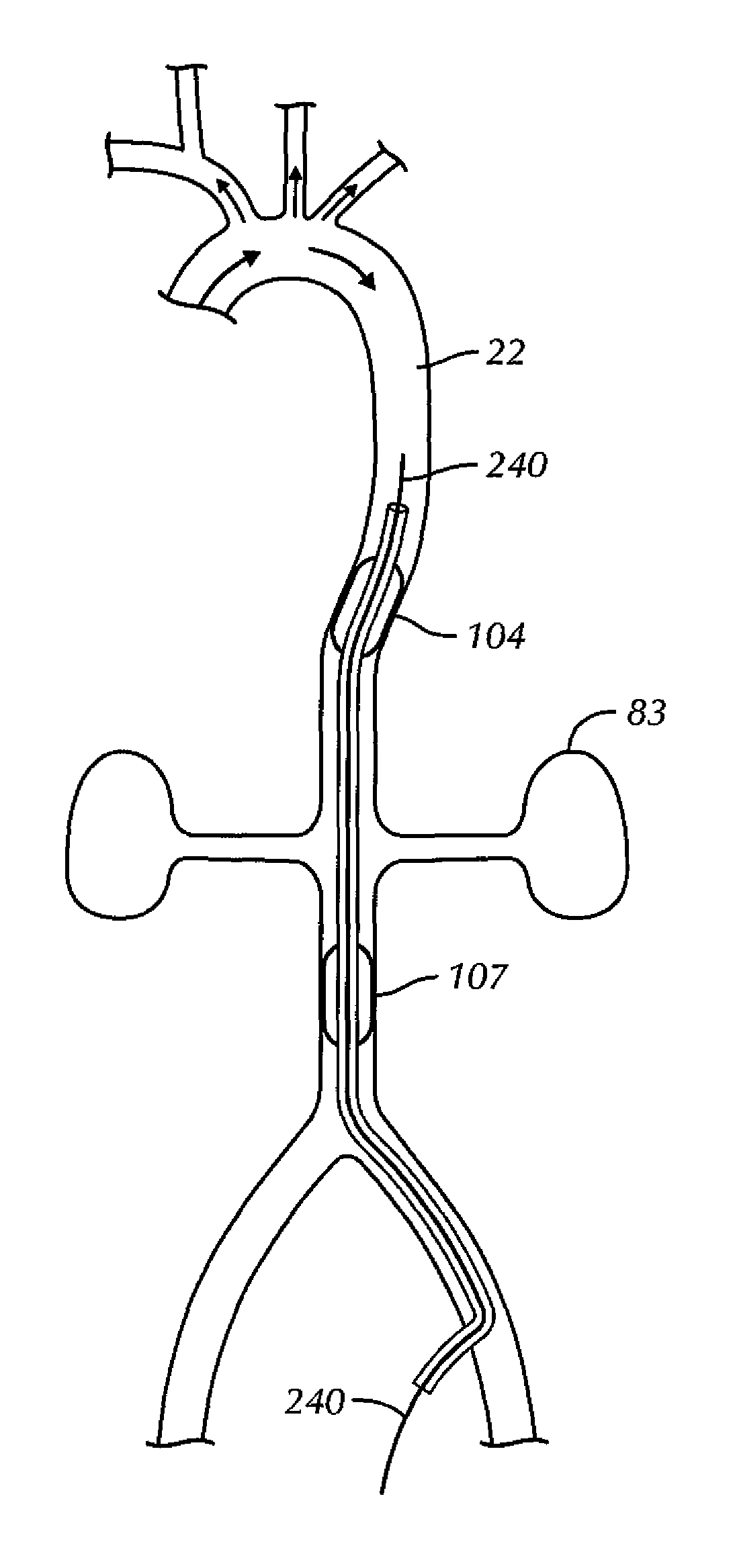 Aortic occluder with tensioned balloons