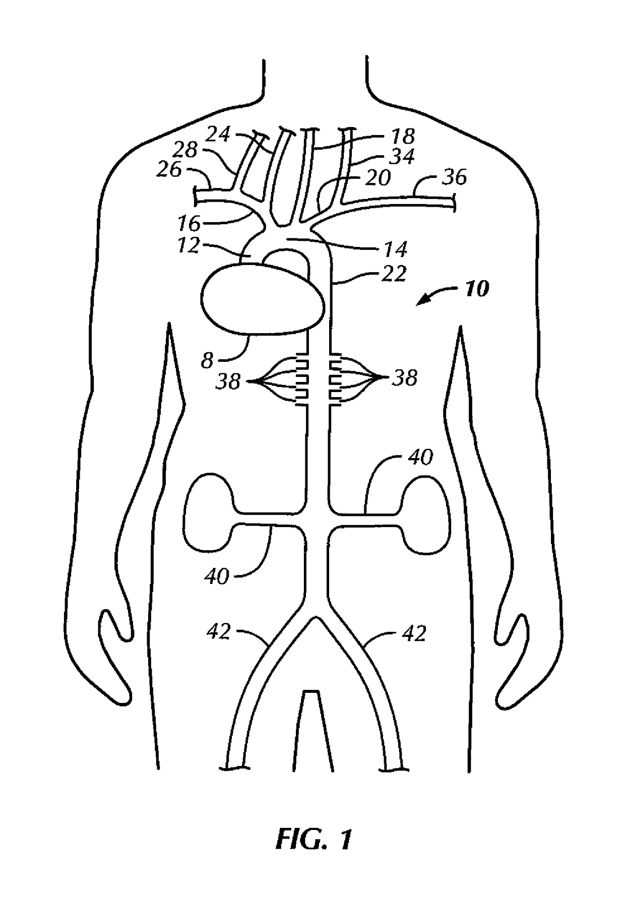 Aortic occluder with tensioned balloons