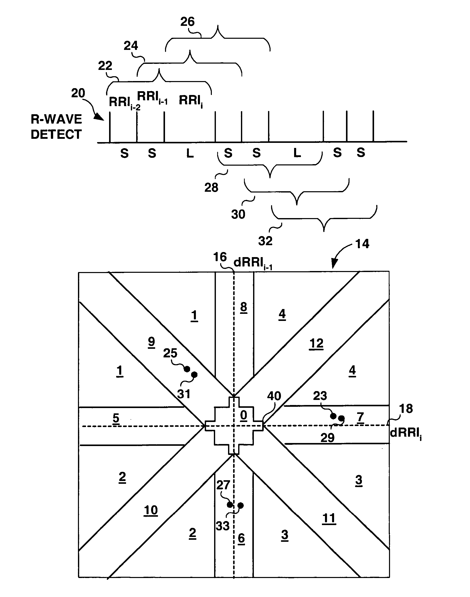 Method and apparatus for detection of tachyarrhythmia using cycle lengths