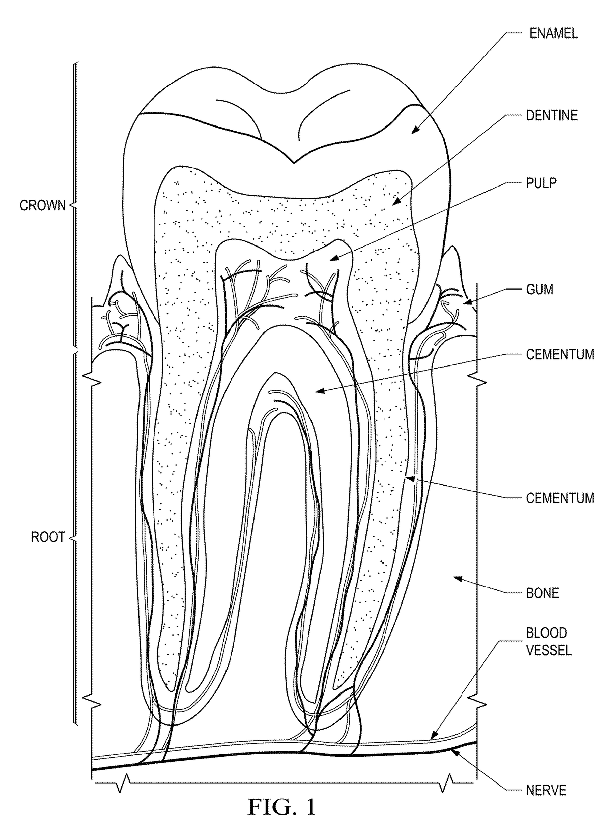 Fluoride releasing bite plate