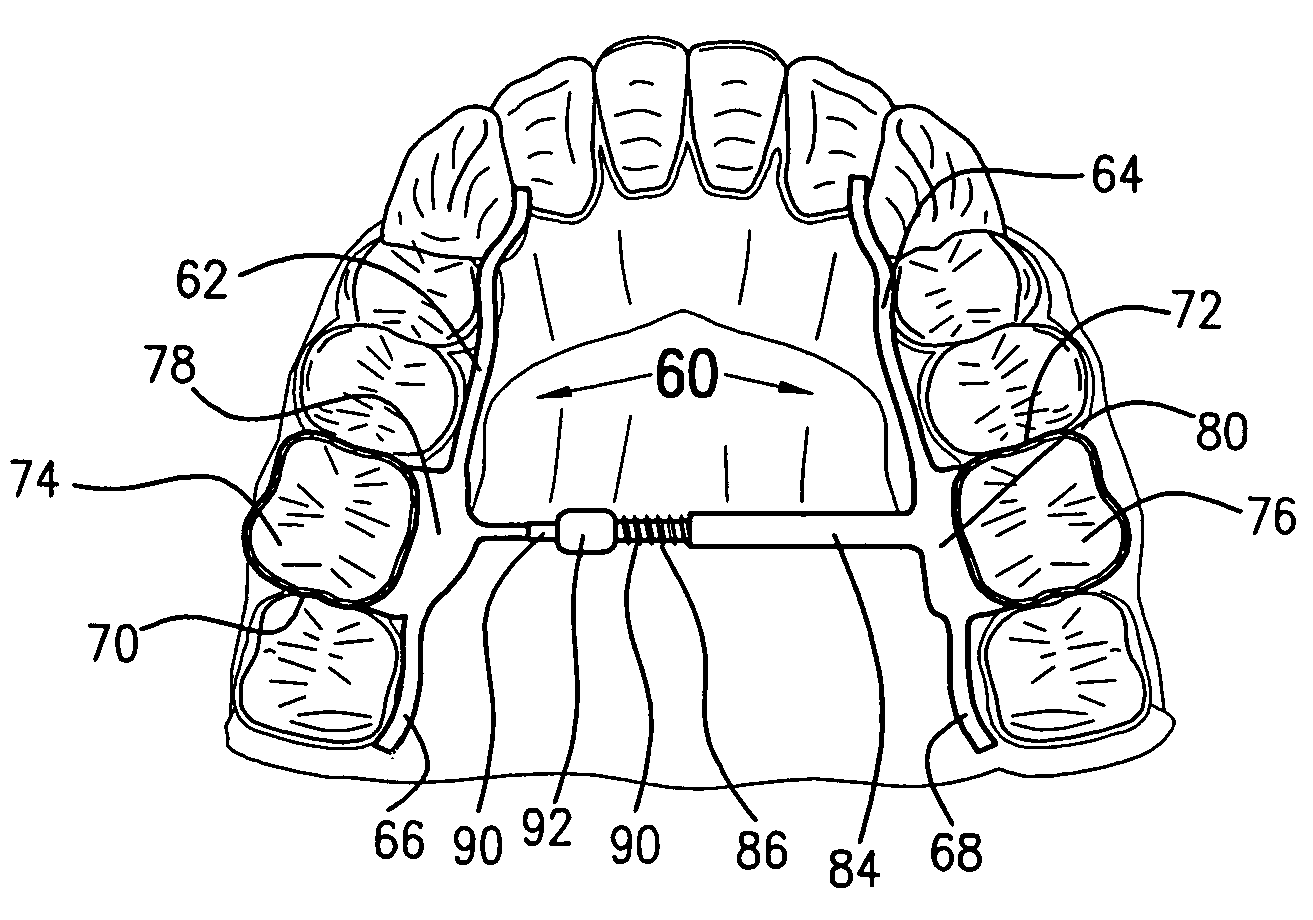 Self-locking power component for orthodontic appliances