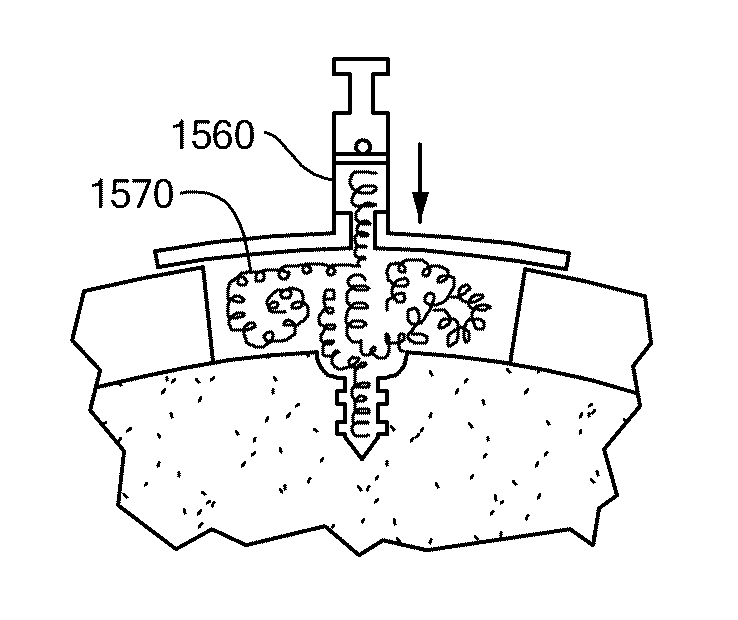 Patient Selectable Joint Arthroplasty Devices and Surgical Tools