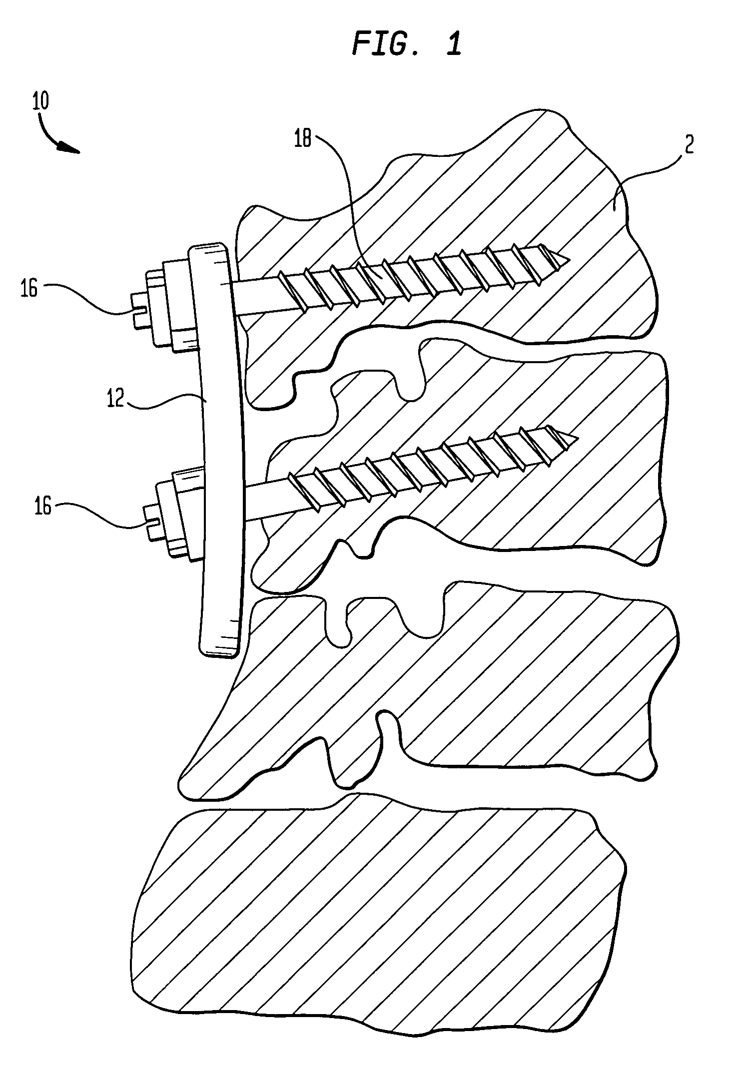 Multi-axial bone plate system