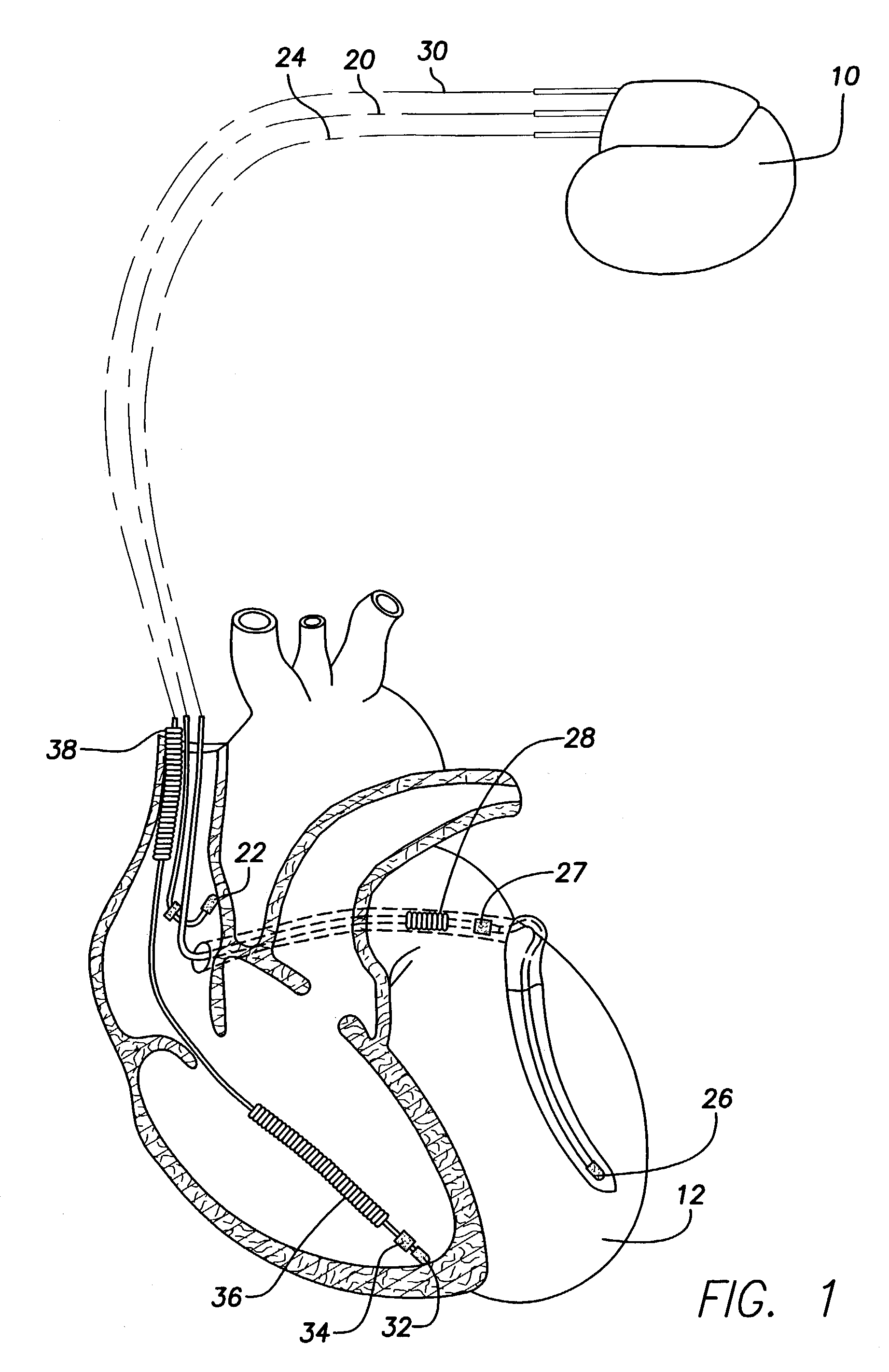 Implantable cardiac stimulation device that minimizes parasitic muscle stimulation and method