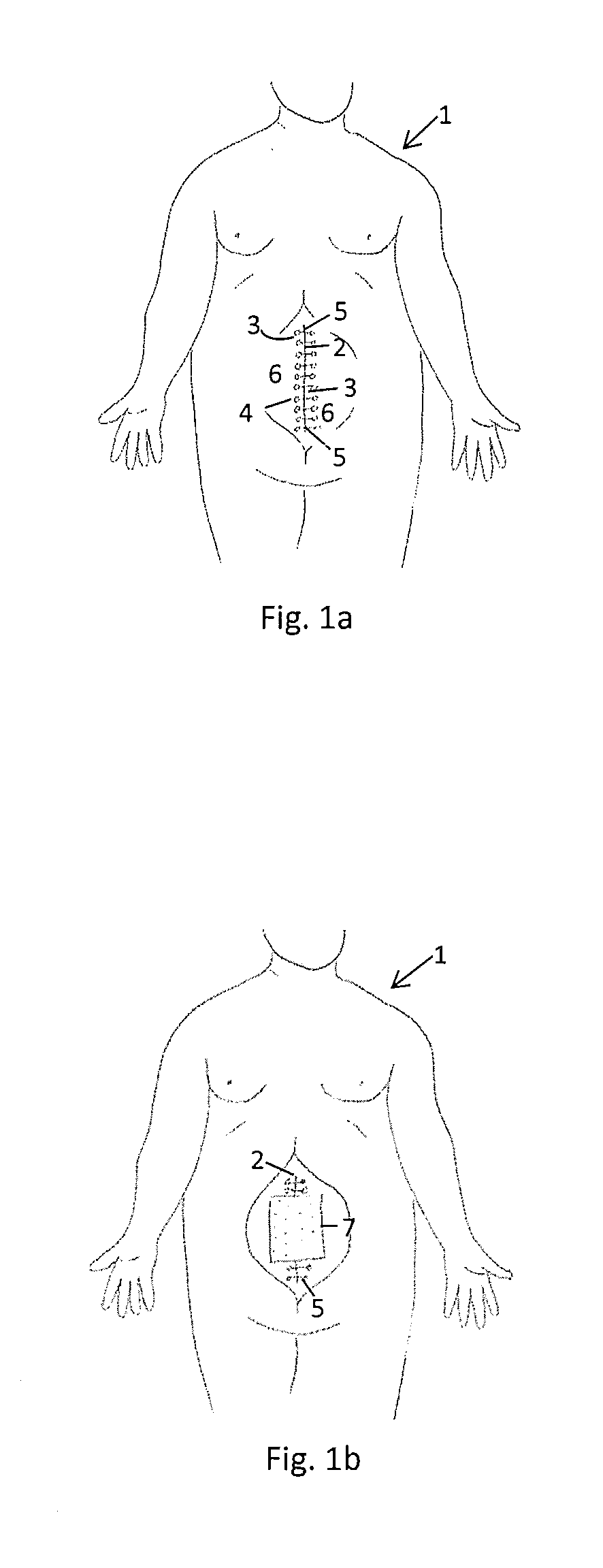 Synthetic and resorbable medical mesh implant with varying mechanical characteristics