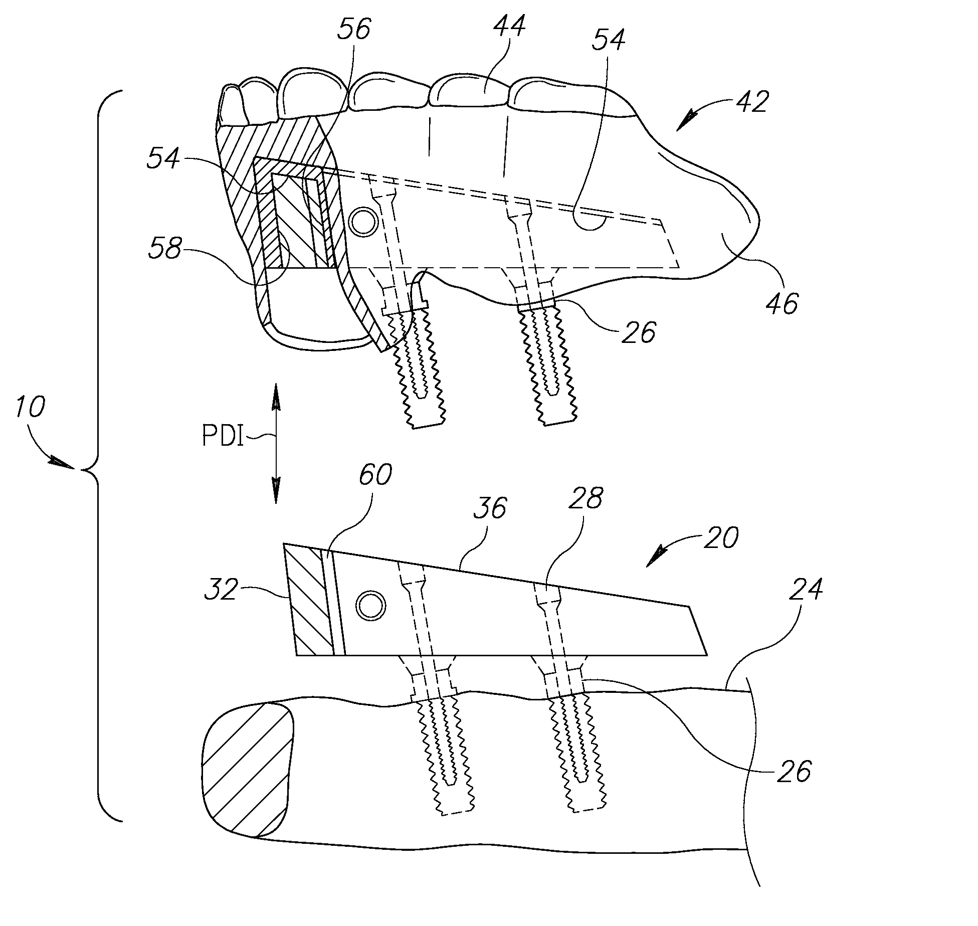 Denture stabilization system and method