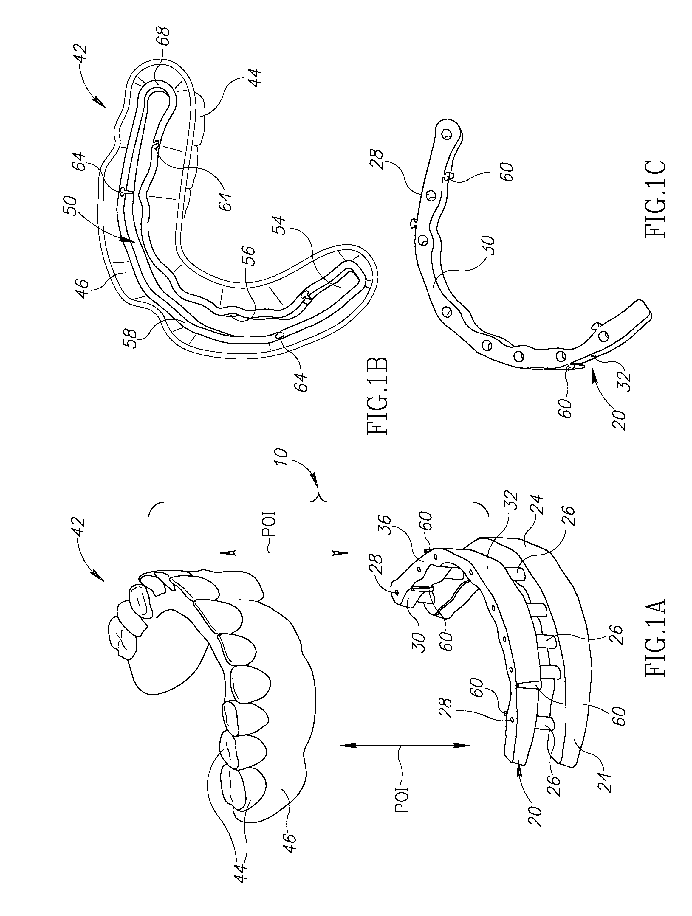 Denture stabilization system and method