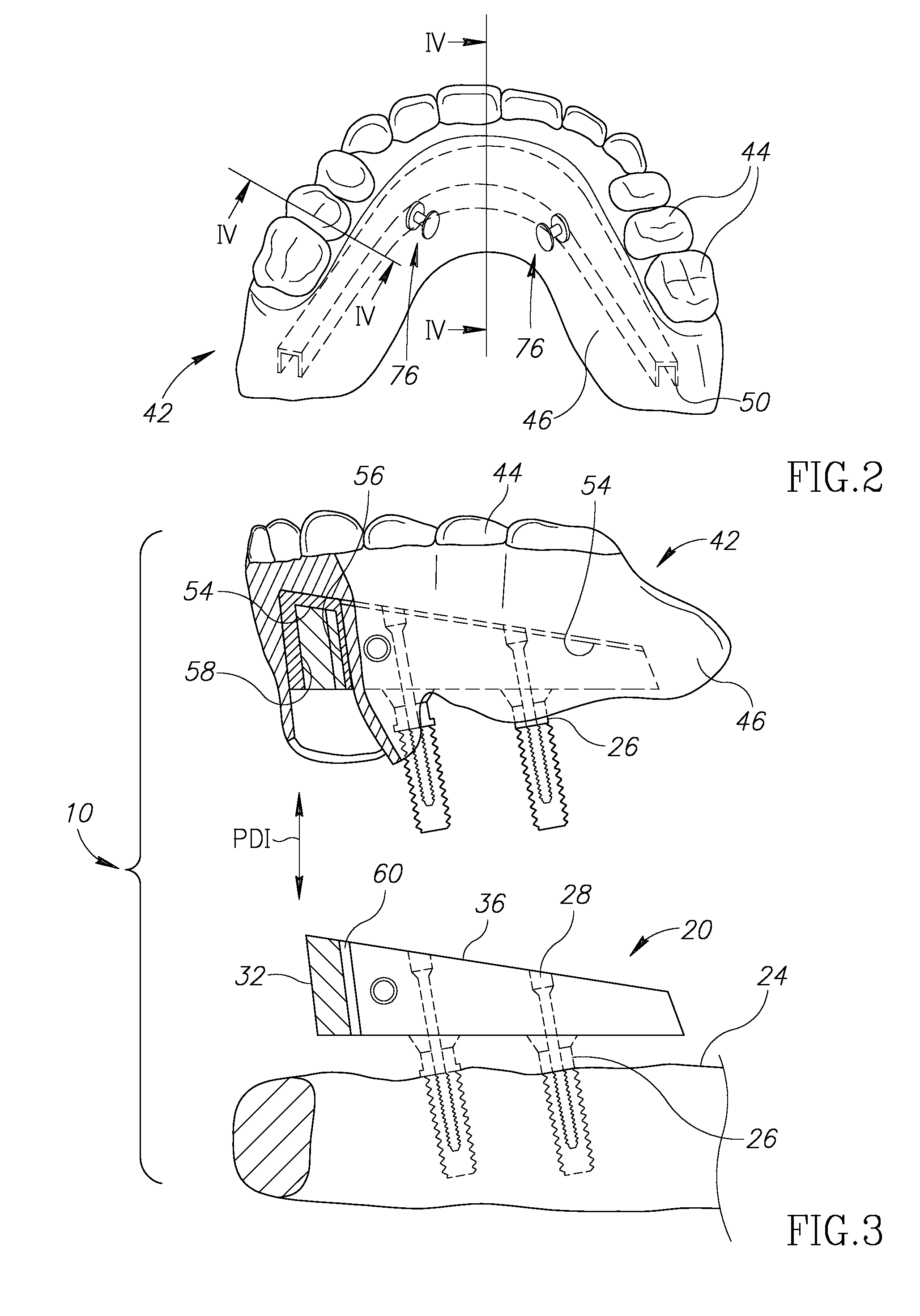 Denture stabilization system and method