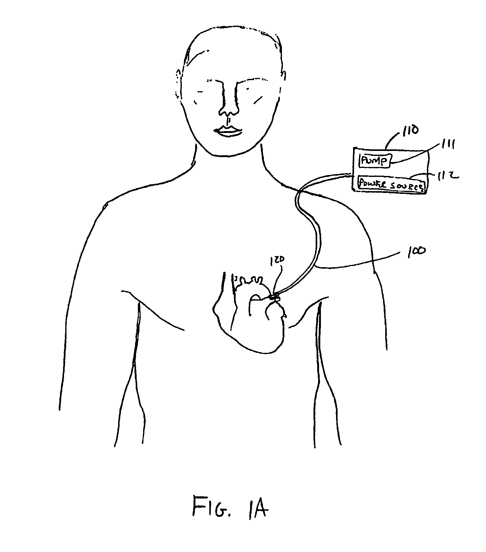 Neurotoxic agents and devices to treat atrial fibrillation