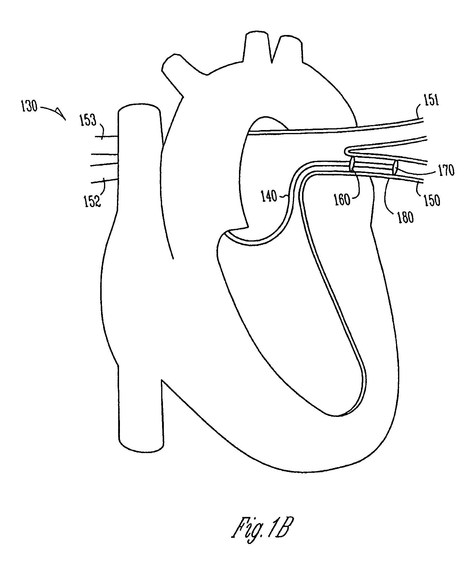 Neurotoxic agents and devices to treat atrial fibrillation