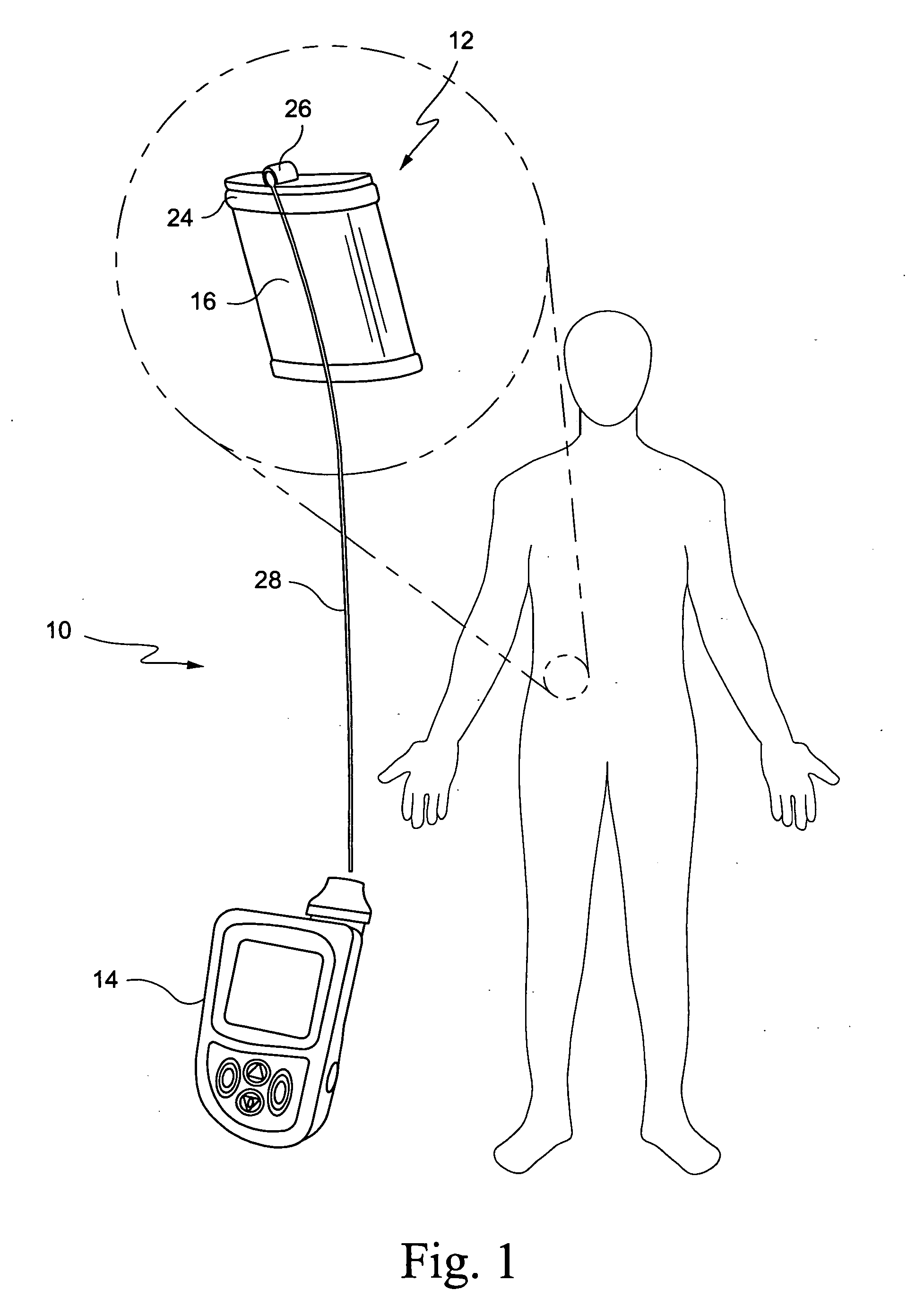 Hybrid device for cell therapies