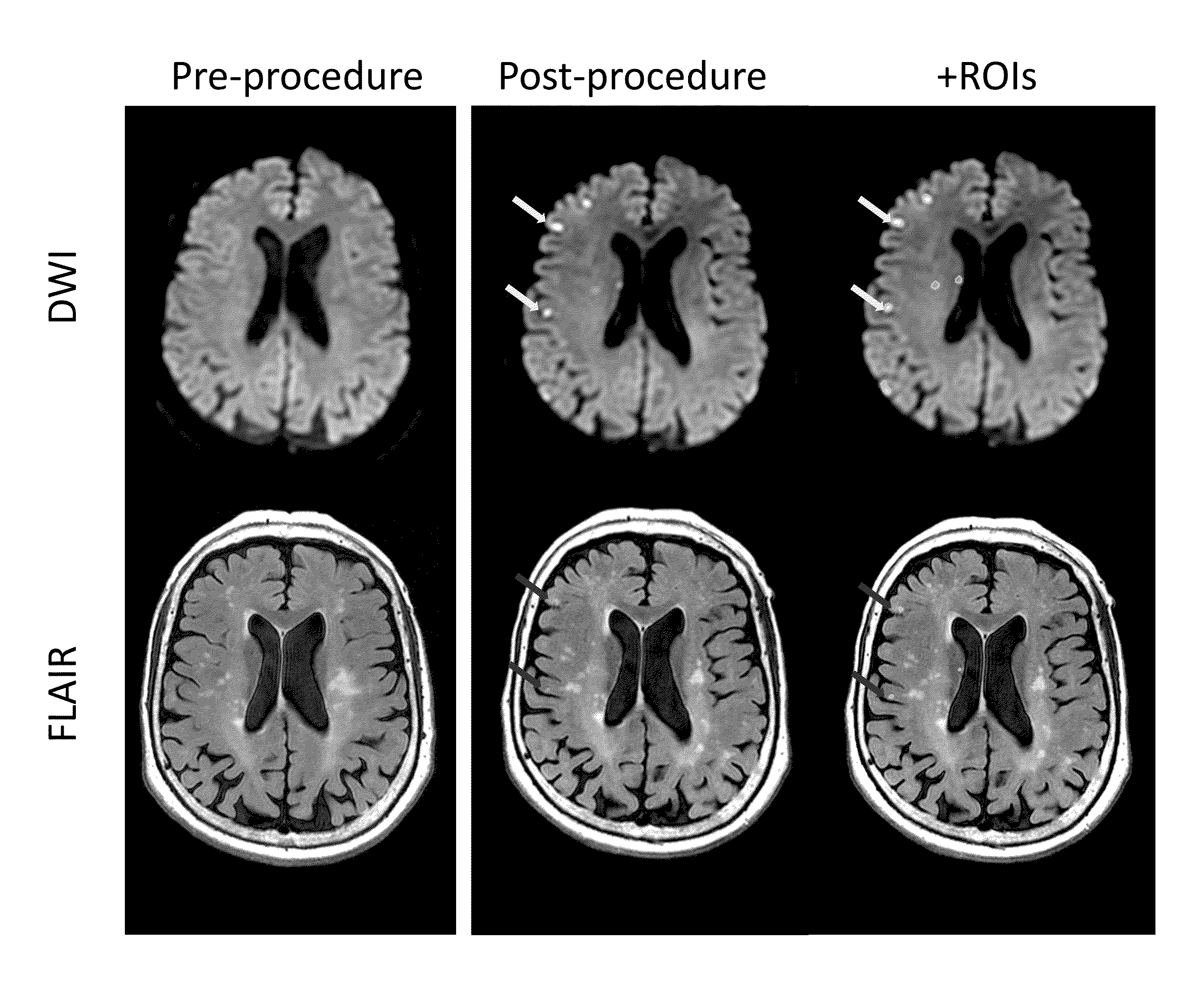 Therapy for subarachnoid hemorrhage and ischemia