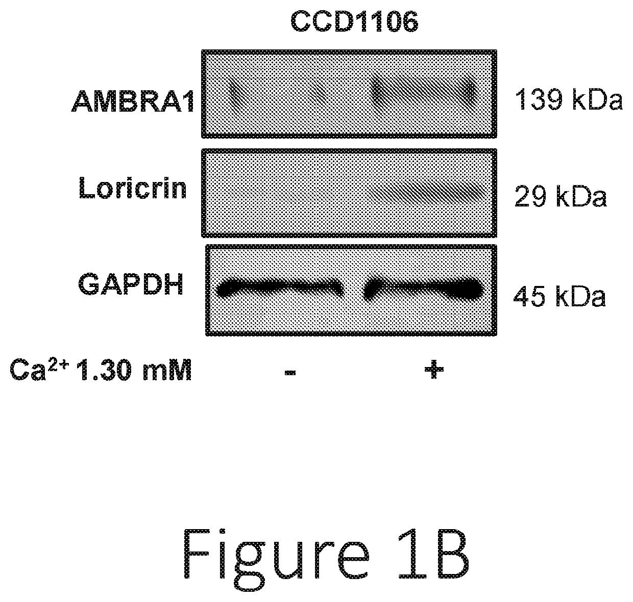 Biomarkers for disease progression in squamous cell carcinoma