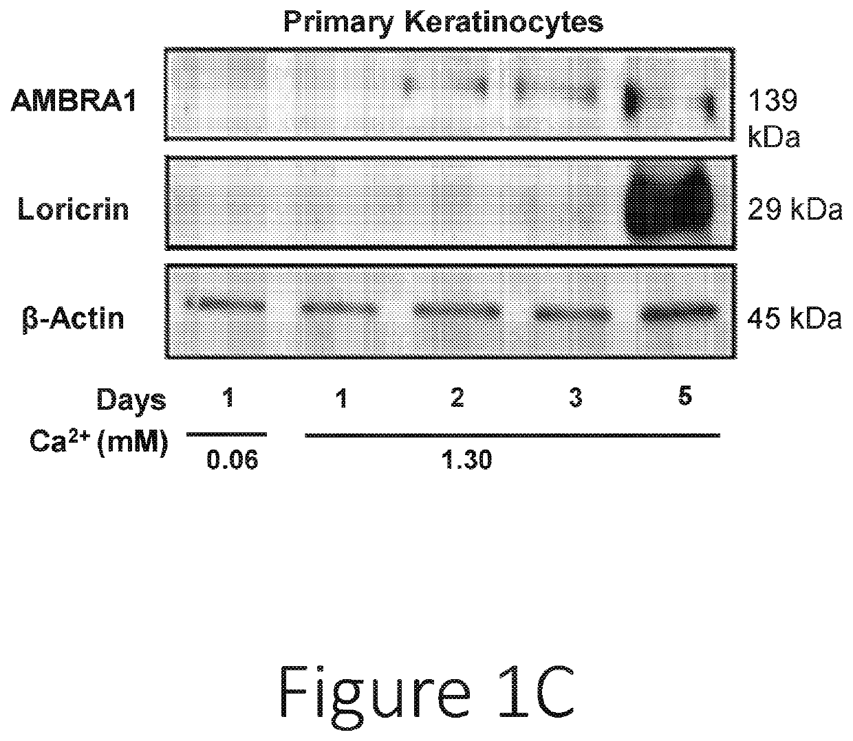 Biomarkers for disease progression in squamous cell carcinoma