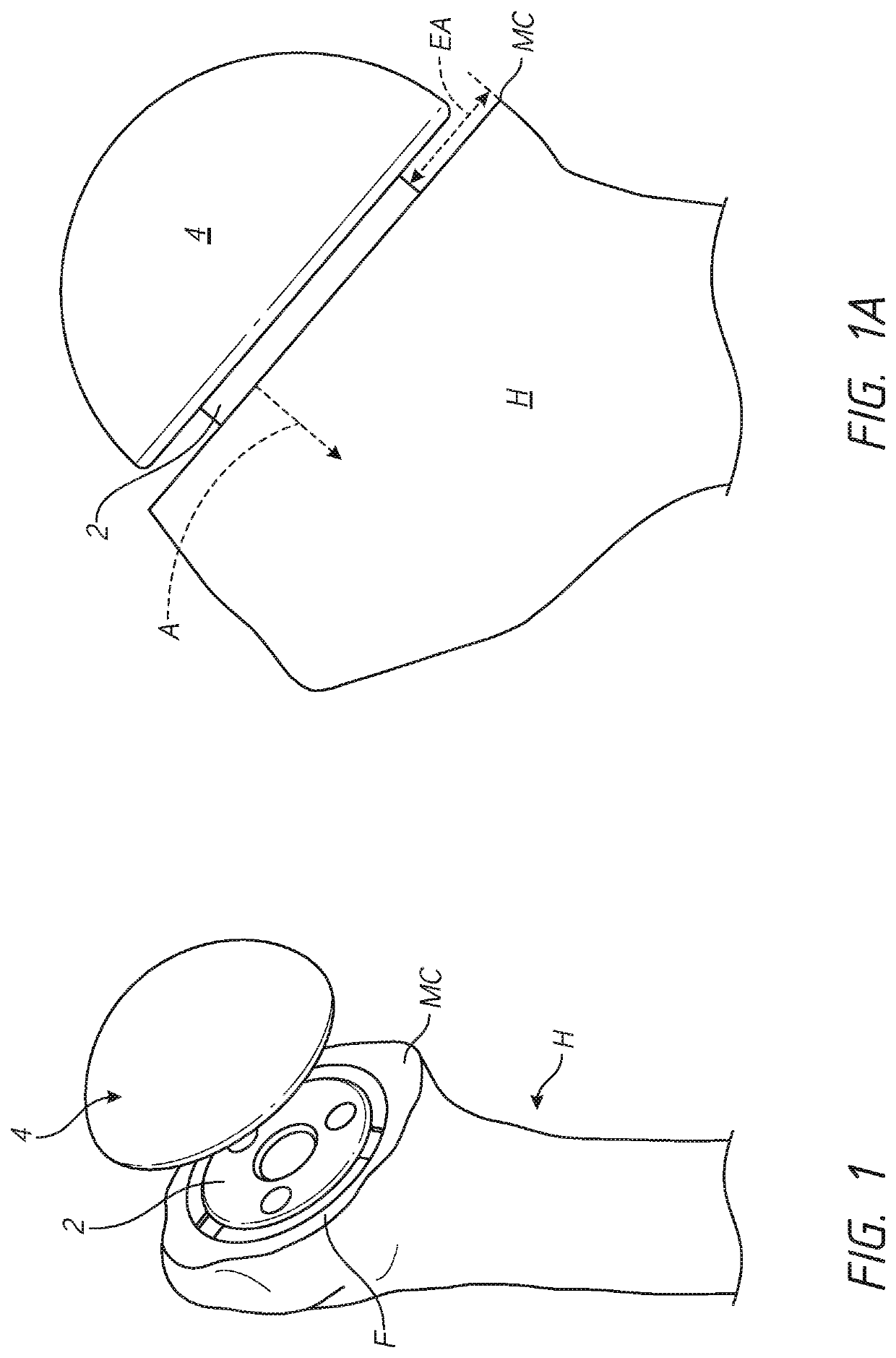 Patient specific stemless prosthesis anchor components