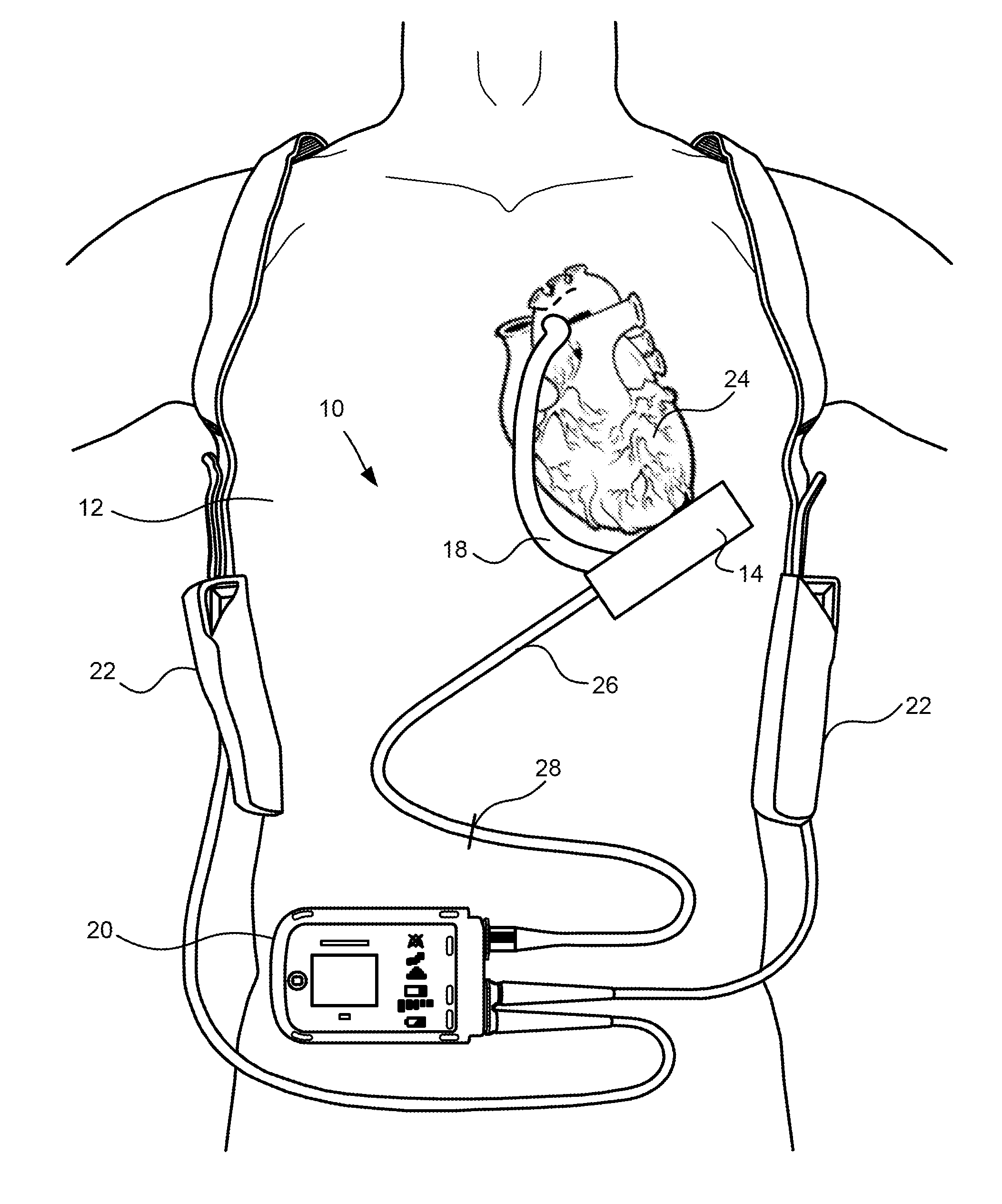 Cantilevered rotor pump and methods for axial flow blood pumping