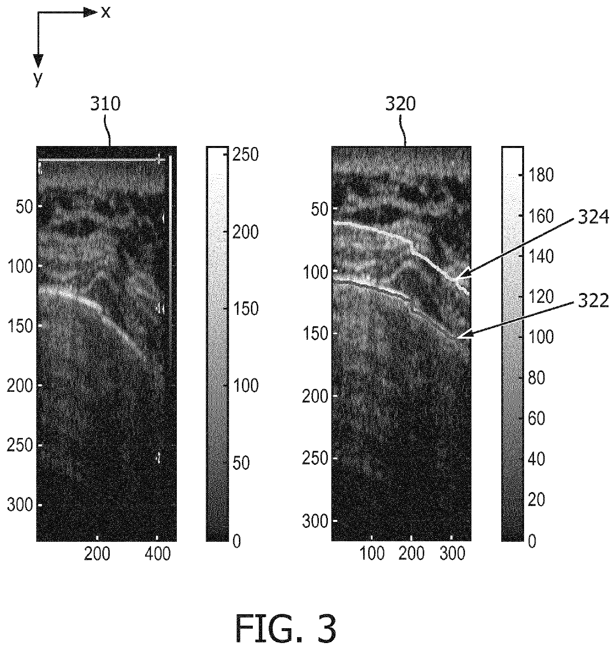 Apparatus and method for detecting bone fracture