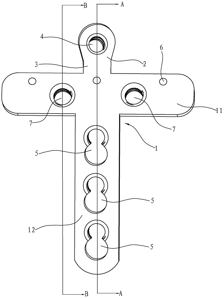 Ulna coracoid process lateral column steel plate