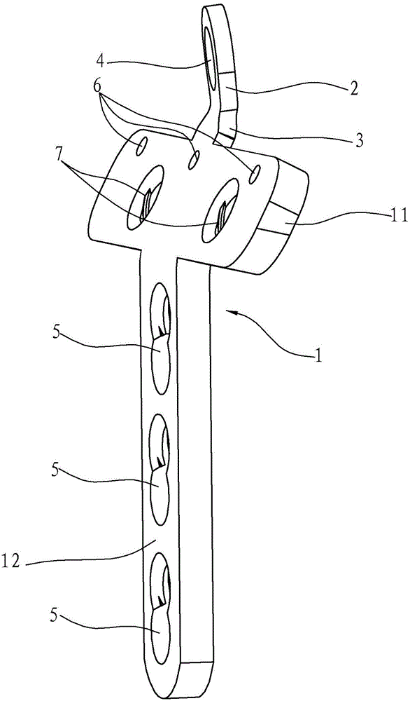 Ulna coracoid process lateral column steel plate