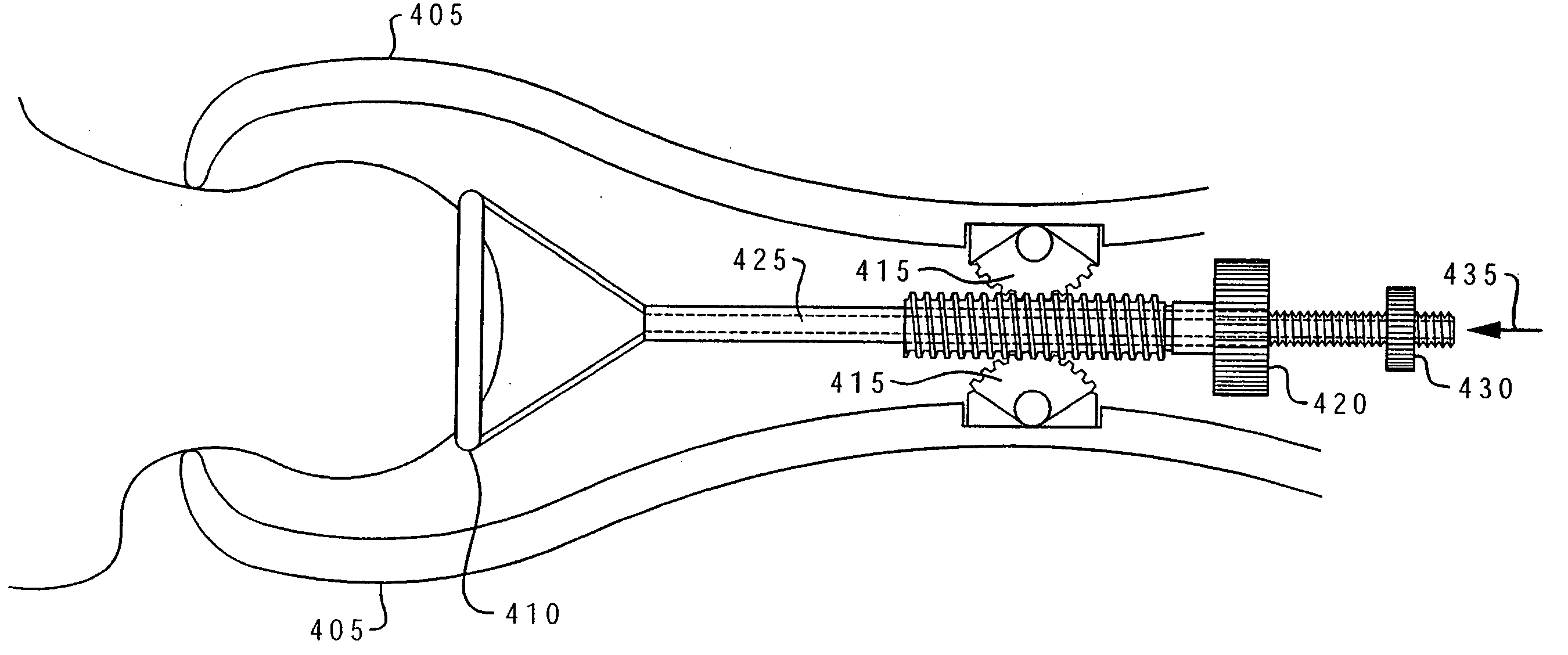 Method of resecting a femoral head for implantation of a femoral neck fixation prosthesis