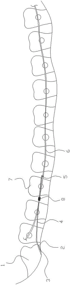 Orthodontic auxiliary arch for impacted wisdom teeth