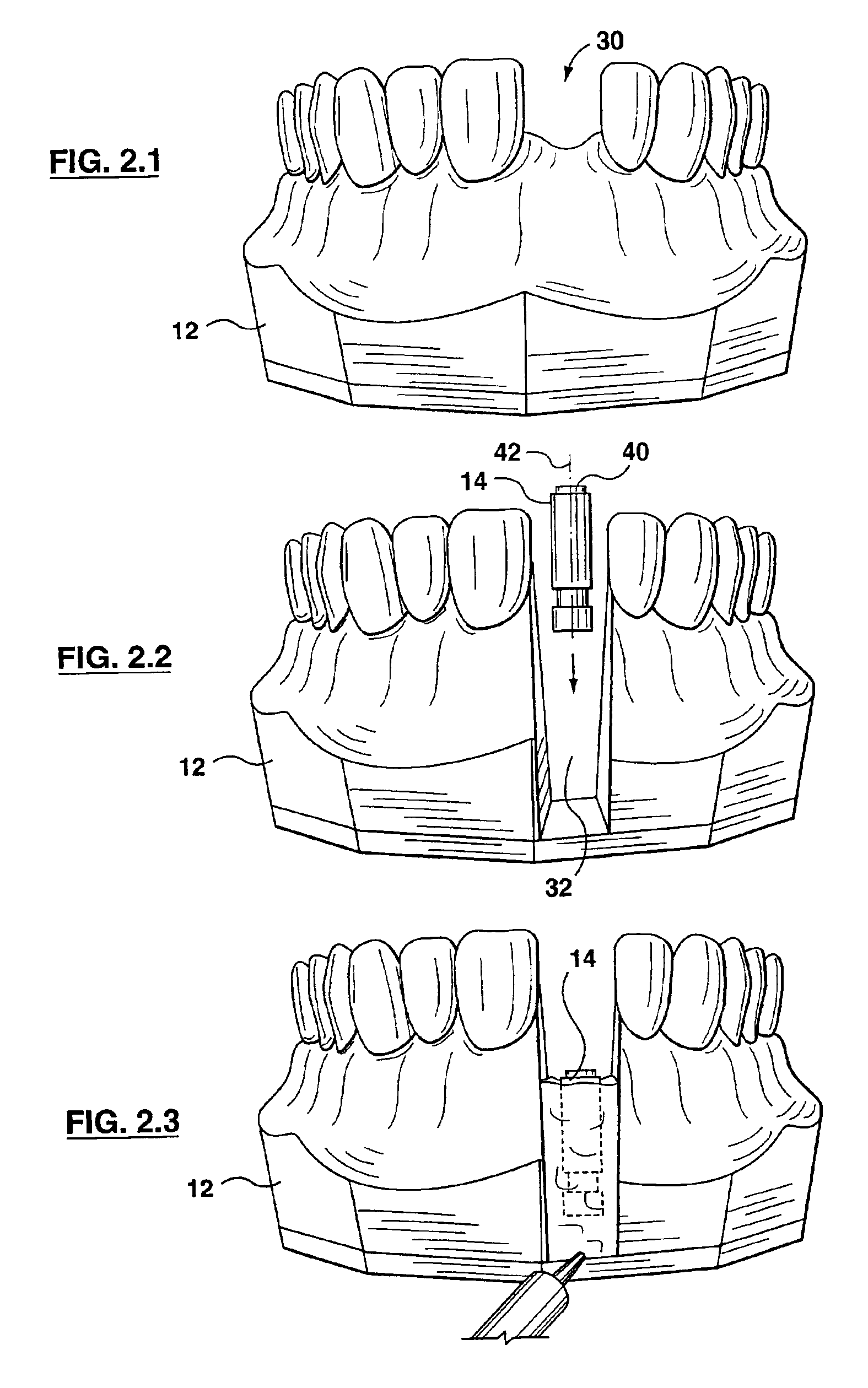 Implant positioning device and method