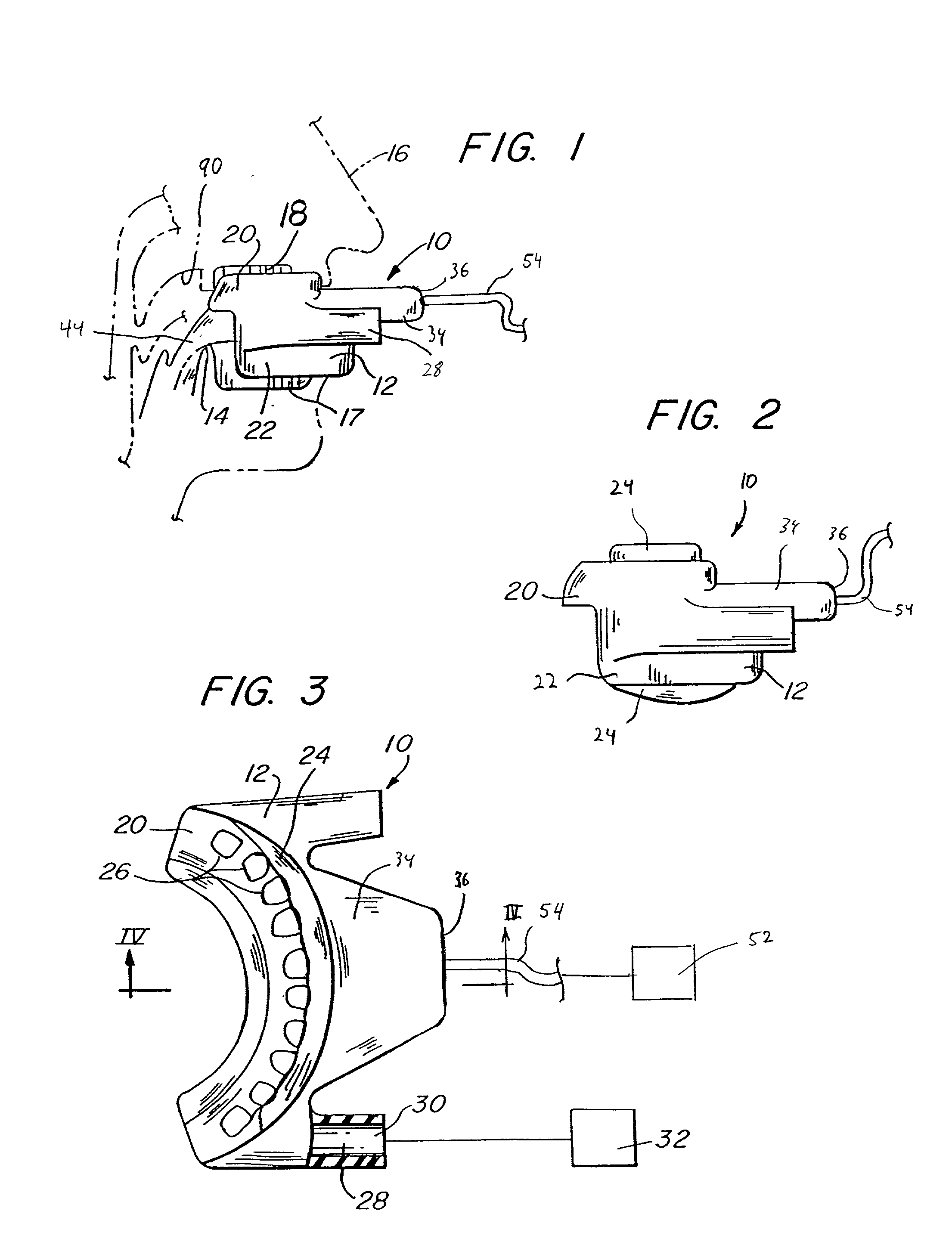 Intraoral apparatus for enhancing airway patency