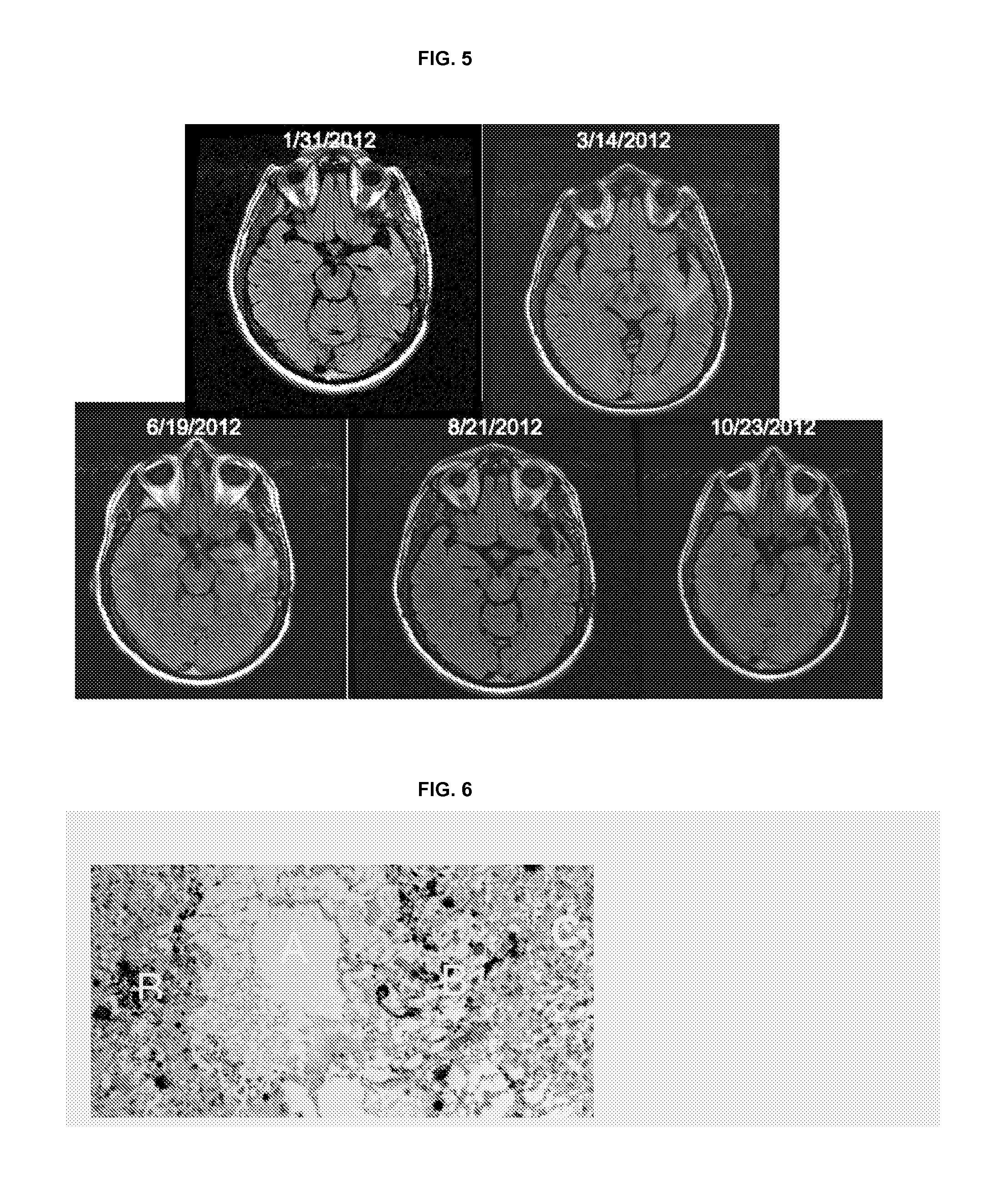 Treatment of brain cancer with oncolytic adenovirus